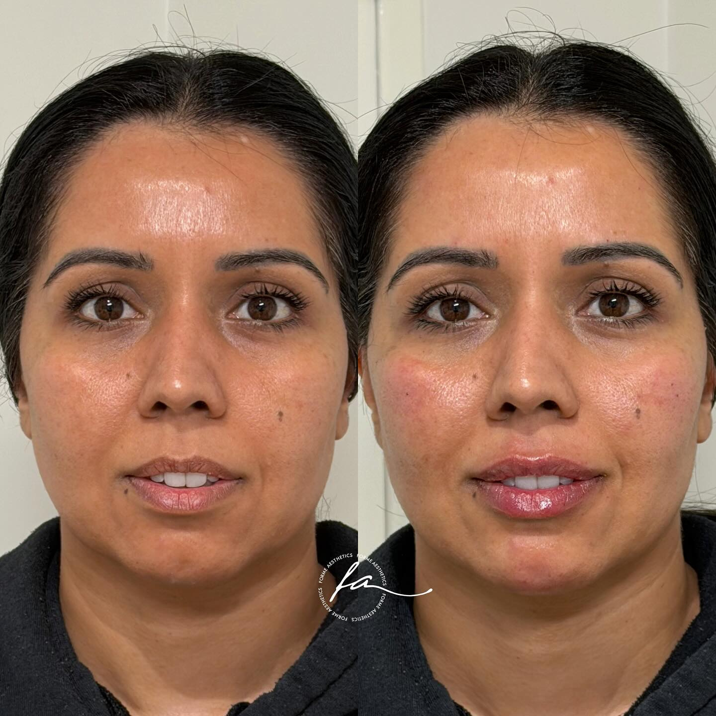 Each face tells its own story, which is why every treatment plan is unique. The goal? Subtle, natural harmony that still feels like you.
📍 Doncaster East, Melbourne
💻 www.formeaesthetics.com
Disclaimer: All medical procedures carry potential risks and side effects. Outcomes vary between individuals and cannot be guaranteed. A consultation with a qualified health professional is required to determine suitability and to discuss possible risks, benefits, and alternatives.