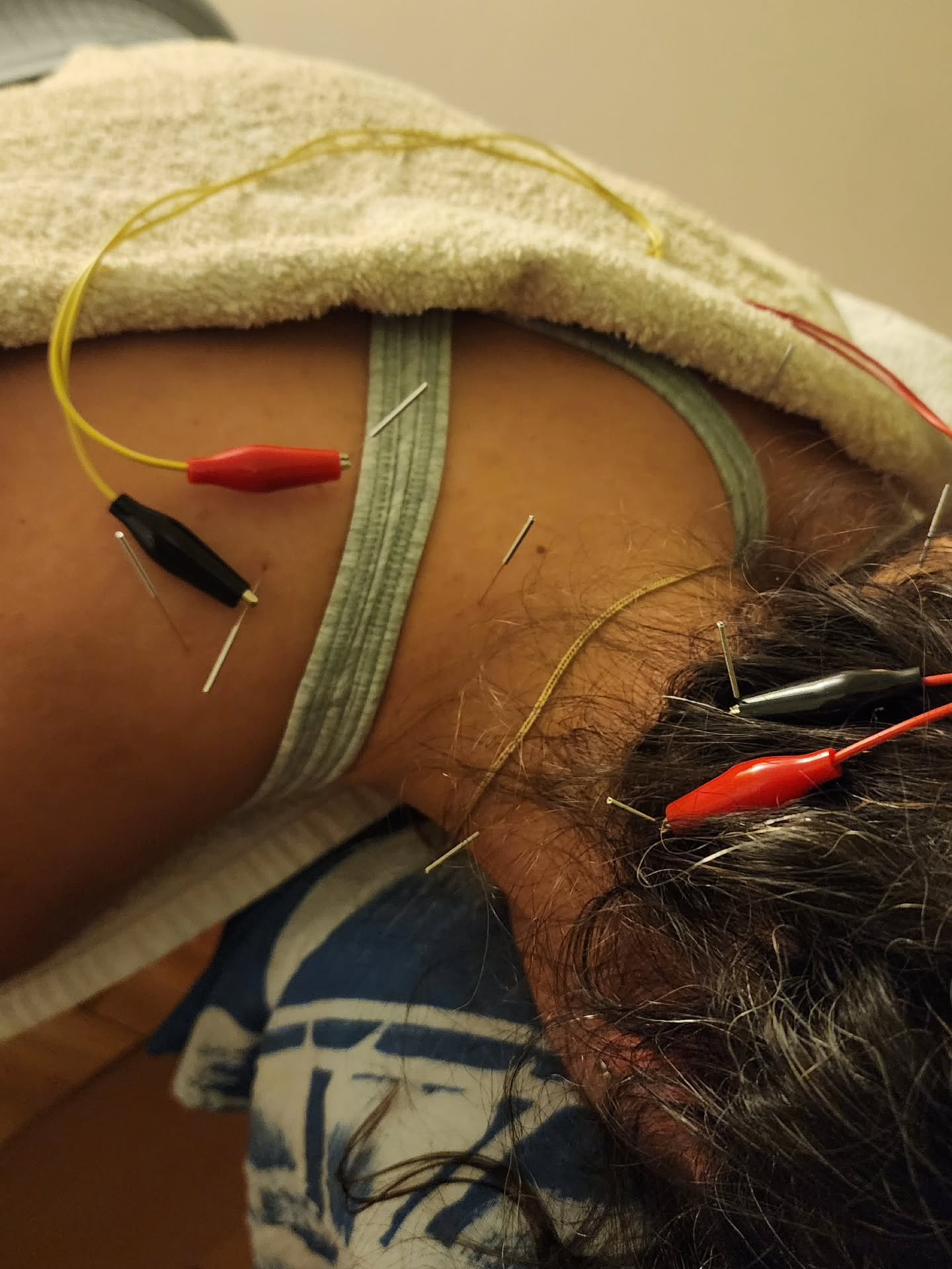 Just this.
>>>
#acupuncturelife #acupunctureneedles #electroacupunture #acutepain #chronicpain #acupuncture #acupuncturedoctor #acupuncturist #shoulderpain #neckpainrelief #acupunctureworks #acupuncturerocks #acupuncturebrisbane #acupunctureforpain #timetoreset #electroacupunture