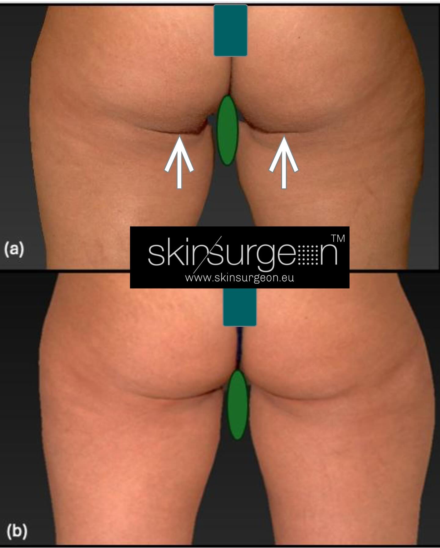 Our signature LARAM laser micro endoscopic access technique gives great results which are discreet and with minimum disruption to your lifestyle. Mixing powerful custom built lasers to hologram mixed reality systems we are able to bring unparalleled accuracy spreed and comfort, all under local anaesthetic and done awake
Skinsurgeon. Redefining Aesthetics.
We innovate
Just because you matter
Info@skinsurgeon.eu
Www.skinsurgeon.eu
#laser #buttockfold #contouring #consultantplasticsurgeon