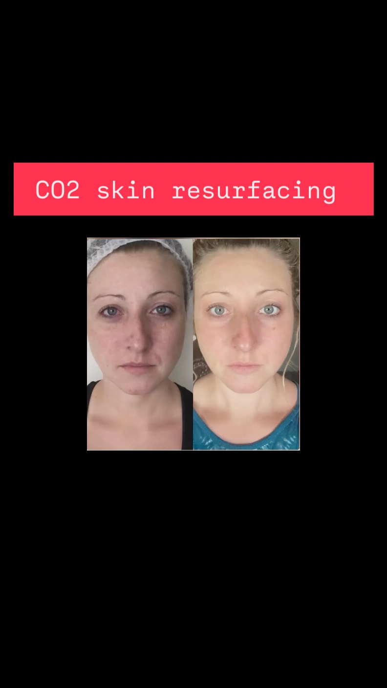 What CO, Laser Resurfacing Can Do for Saggy Skin:
• Tightens mild to moderate loose skin (like around eyes, cheeks, jawline).
• Improves skin texture, fine lines, sun damage, and makes skin look smoother..
#capricebeautybar #age #tampabay #sarasota #sarasotaflorida #hifu #age #co2laser #co2