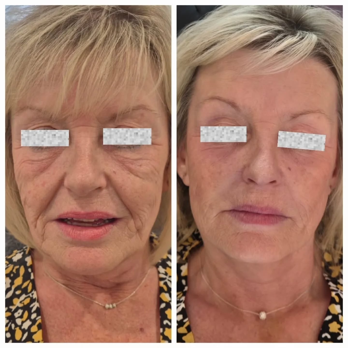 Not a Skin Specialist 2025 Finalist for nothing ✨
This transformation is proof that when you commit to a long-term plan with the right treatments and the right practitioner, your skin can truly transform — not just for a few weeks, but for life.
This beautiful lady came to see me just over a year ago. I’ll never forget her first consultation — she burst into tears, telling me how self-conscious she felt about her skin and how much it affected her confidence. Fast forward one year, and she walked into my clinic glowing, smiling… and wearing the same dress she wore that first day — but this time, with a completely different energy. That’s what confidence looks like.
Her treatment plan was tailored carefully and strategically:
✨ PRP under the eyes to stimulate collagen and improve texture
✨ Microneedling for the full face to refine pores and resurface skin
✨ Under-eye polynucleotides to restore volume and elasticity
✨ Cheek filler and nasolabial line filler to support facial structure and lift
Each treatment worked in synergy to gradually rebuild her skin from the inside out — improving tone, texture, hydration, and firmness over time. There’s no single “miracle” treatment; real results come from consistency, professional guidance, and trust in the process.
When you invest in me, you’re not just booking a single session — you’re committing to a journey of skin health, confidence, and rejuvenation. My goal is to help you age backwards by focusing on long-term results, not quick fixes.
Because beautiful skin doesn’t happen overnight — it’s built, layer by layer, with the right science, skill, and strategy.