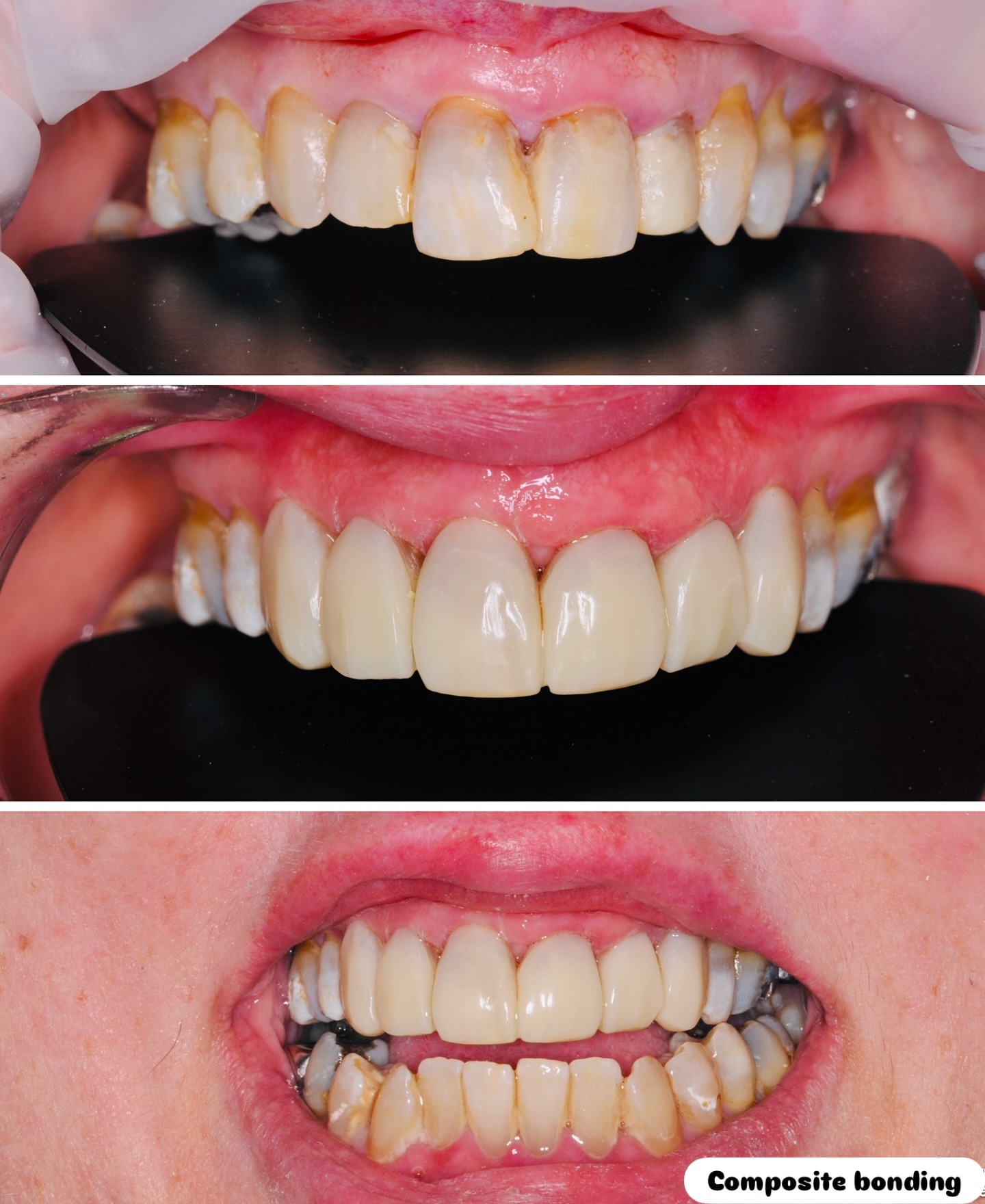 Another case of freehand composite bonding for a patient not happy with their discoloured teeth #compositebonding #smilemakeover #smileimprovement #compositebondingmanchester #compositeveneers #compositebondingprestwich #stainedteeth #smile #smileeveryday #smiledesign