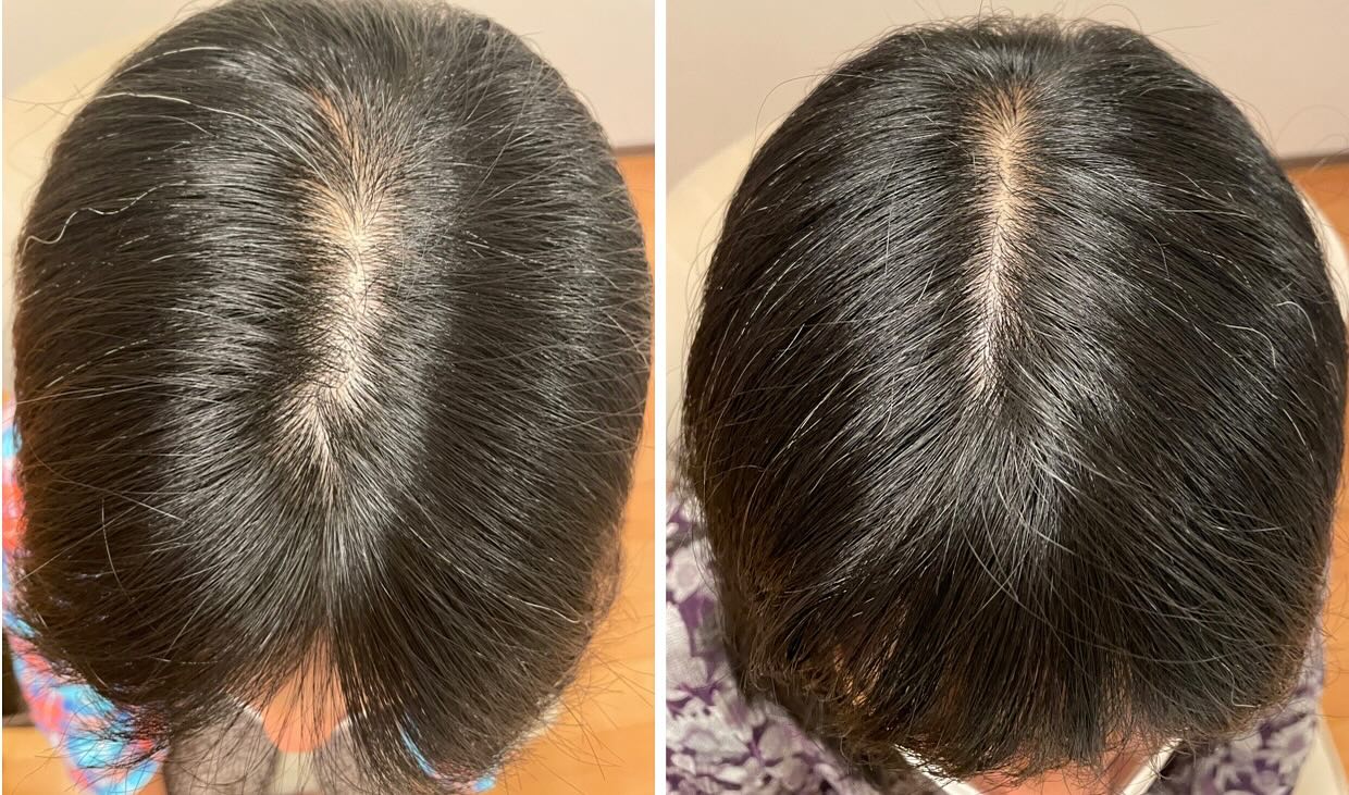 モニター様
週1で通って頂いているお客様です♪
薄毛の部分の効果が早く喜んでます♥️