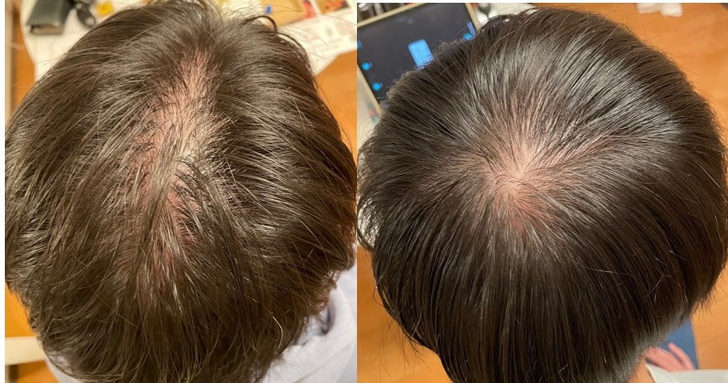 モニター12回目終了したお客様です♪
かなりの変化が見られて、本人様も喜ばれてます😆
まだまだ理想に近づくために、継続して頑張っていく予定なので、今後も楽しみです🌟