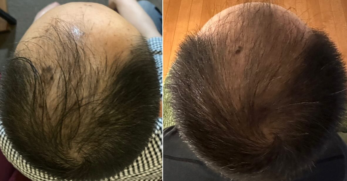 モニターが終わっても頑張って通い続けてきているお客様です♪
最初の頃に比べると効果がしっかりと現れています😆👌