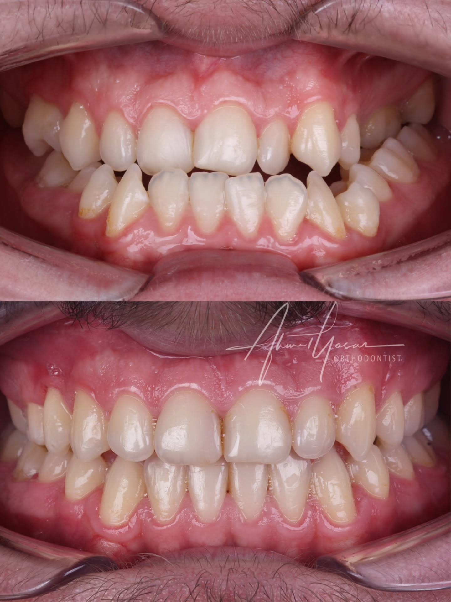 Orthognathic surgery / Çift çene ameliyatı.
.
Our clinic is authorized by the Ministry of Health of the Republic of Türkiye for International Health Tourism. All patients have been informed and have provided consent for the use of their photographs on our social media platforms. All content shared on social media is intended to inform patients about procedures and should not be perceived as advertising. Outcomes of any surgical or interventional treatment may vary from person to person. It is recommended to consult your physician for detailed information before undergoing any procedure.
.
.
.
#ortodonti #ortodontist #bursa #bursaortodonti #bursaortodontist #bursaortodontiuzmanı #orthodontics #braces #teltedavisi #dişteli #orthognathicsurgery #invisalign #diş #şeffafplak #lingualortodonti #dişteli #çeneameliyatı #selfligating #kapaklıbraket #gülüştasarımı #dişhekimi #dentistry #photography #estetik #dentalart #ahmetyasar #drahmetyasar