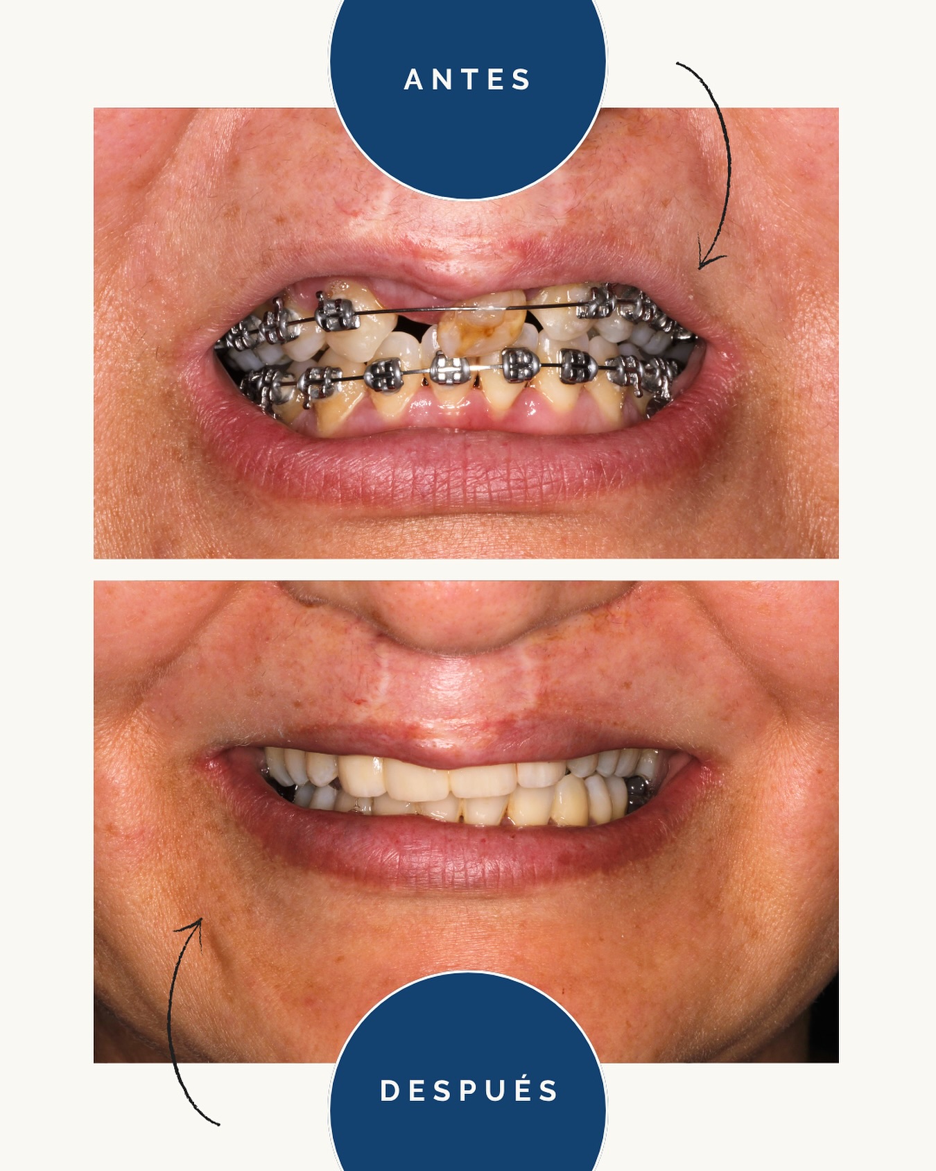 🦷 ¡Descubre la sonrisa que transforma vidas! 🦷
En nuestra Clínica, especializada en Cirugía del Fisurado, comprendemos la importancia de un tratamiento integral y contamos en nuestro equipo, con una ortodoncista especializada en Ortodoncia del Fisurado.
La ortodoncia desempeña un papel crucial en el camino hacia una sonrisa radiante y funcional para nuestros pacientes.
👩⚕️Aquí os presentamos un caso antes de empezar el tratamiento, durante y por último tras estética dental.
El objetivo en ortodoncia fue dar mayor amplitud al maxilar y colocar el incisivo en una mejor posición.
Con la ortodoncia en el Fisurado, no solo buscamos la alineación perfecta de los dientes, sino también la armonía facial y la funcionalidad óptima.
🤗Cada sonrisa es única, y nuestro equipo está comprometido a diseñar un plan de tratamiento personalizado que se adapte a las necesidades específicas de cada paciente.
¡Recuerda! Más que corregir la estética, la ortodoncia en fisura labial contribuye a mejorar la salud bucal y la confianza de nuestros pacientes.
¡Ven y descubre cómo podemos transformar tu sonrisa! ✨
#FisuraLabial #Ortodoncia #SonrisaTransformadora #clinicadental