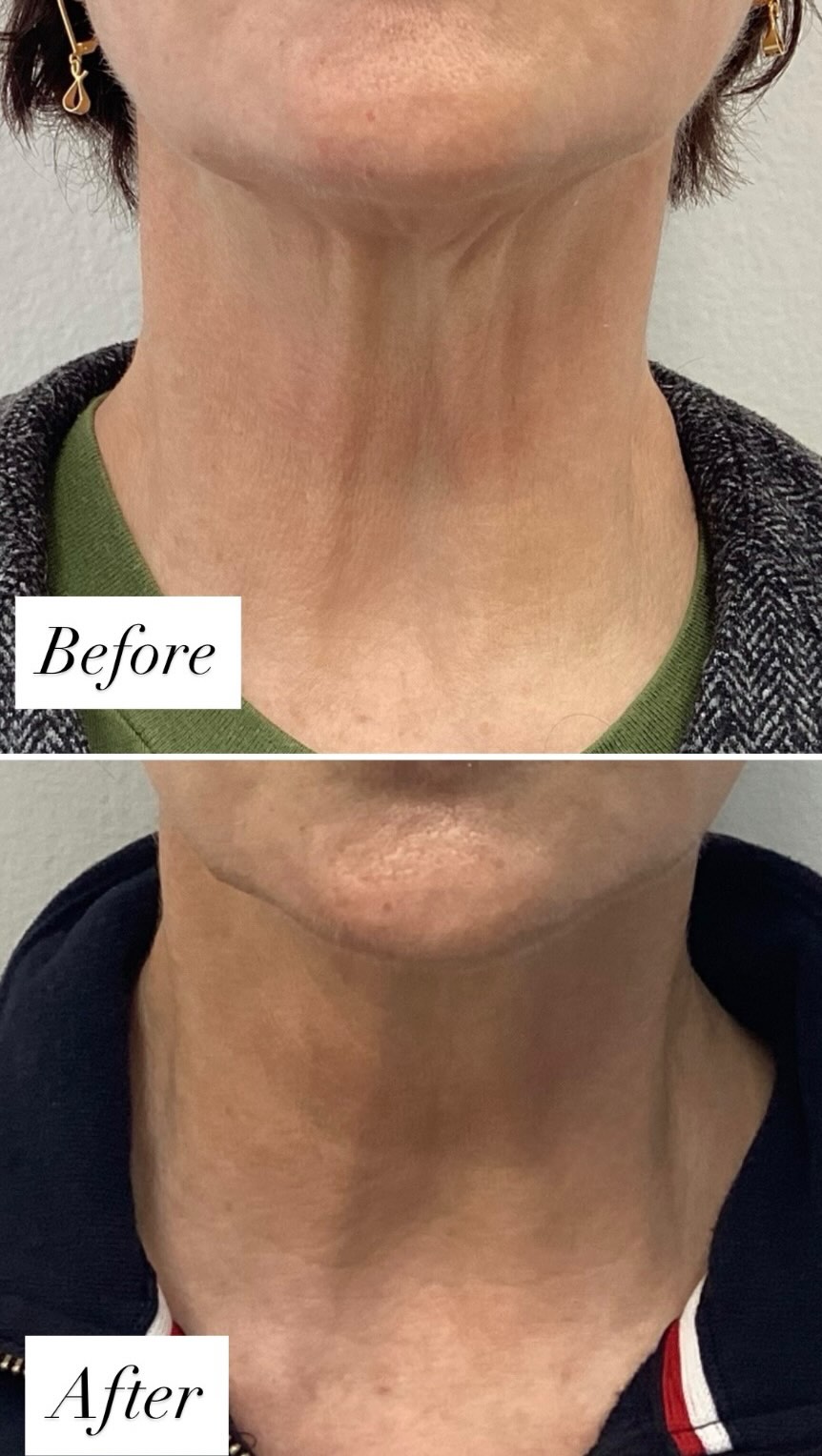 ✨ Neck rejuvenation in action ✨ Watch our RN Kaeleen perform a Radiesse® treatment designed to lift, smooth, and restore definition to the neck.
This collagen-stimulating filler helps improve firmness and texture for a more youthful look. We’re running a special Radiesse® promo all October — available while supplies last, so don’t miss your chance to book!!!!
🎥 B/A at the end 👀
#RadiesseNeck #NeckRejuvenation #CollagenFiller #RadiesseBeforeAfter #BayAreaMedspa #Luminaskin #SkinTightening #FillerTreatment #RadiesseResults #AestheticsClinic