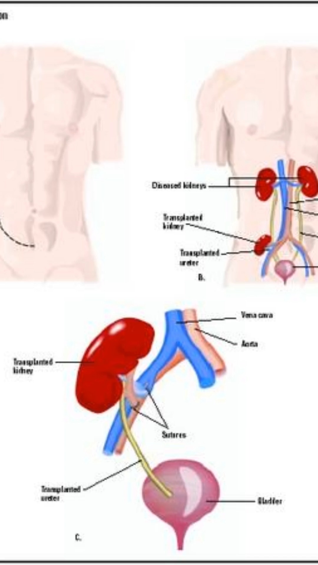 Kidney transplant is the gold standard for end-stage kidney disease. And the outcomes might surprise you...
📊 Current transplant success rates:
- 95% survival at 1 year
- 85% survival at 5 years
- Grafts last 11-19 years on average
- Living donor transplants can happen BEFORE dialysis.
But here's what has me truly excited as a nephrologist...
🐷 March 2024: Mass General Hospital successfully transplanted a genetically modified pig kidney into a living human.
This wasn't experimental fantasy. This was real medicine. Multiple cases have followed, and a large-scale trial is beginning soon.
Why this matters:
Over 90,000 Americans are currently waiting for kidney transplants. Many will die before an organ becomes available. The average wait time is 3-5 years. But xenotransplantation (animal-to-human organ transplants) could change everything.
Imagine:
✨ No more years-long wait lists
✨ Transplants available before dialysis is needed
✨ Genetically modified organs that reduce rejection risk
✨ An unlimited supply of kidneys
We're not just managing kidney disease anymore. We're replacing organs. We're regenerating function. We're entering a new era of medicine.
🔄 Share with someone who needs hope about kidney treatment
💬 Honest question: Would you accept a pig kidney transplant?
Sources:
Survival (patient & graft): SRTR/OPTN Annual Data Reports; Mayo Clinic overview; AJT comparative outcomes.
American Journal of Transplantation;
PubMed Central; SRTR
Pre-emptive transplant guidance: KDIGO 2020 guideline.
Lippincott Journals
Pig kidney transplants: MGH press releases; Harvard Medical Sc
⚠️ MEDICAL DISCLAIMER: This content is for informational and educational purposes only and does not constitute medical advice, diagnosis, or treatment. Kidney transplant candidacy, timing, and treatment decisions must be made in consultation with your nephrologist, transplant team, and healthcare providers based on your individual medical situation. Xenotransplantation is still experimental and not widely available. Individual outcomes and survival rates vary. This content does not establish a doctor-patient relationship.
#KidneyTransplant #Xenotransplantation #KidneyDisease