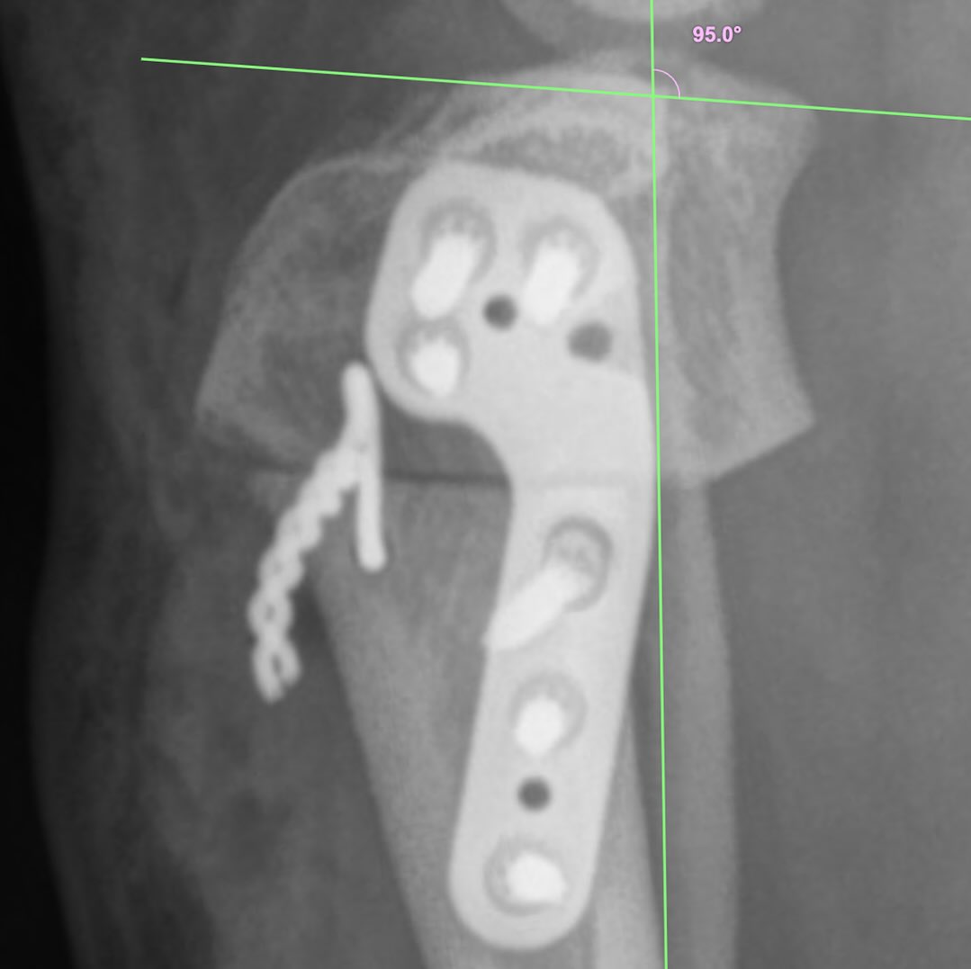 Postoperative 5° TPA achieved following a 37.6° wedge correction in a 4 year old male neutered Yorkshire Terrier Mix with a preoperative TPA of 37°. The modified Cranial Closing Wedge Ostectomy angle was calculated according to equations produced by Moreira et al., (Vet Surg 2024) that adjust for technique-specific tibial long axis shift and tibial shortening magnitude.