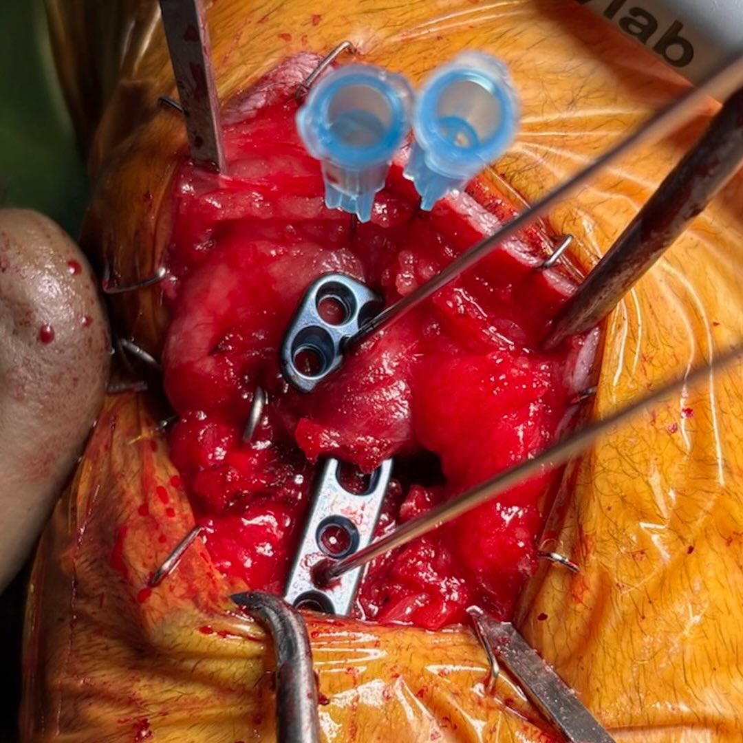 Pes-sparing modified Cranial Closing Wedge Ostectomy (mCCWO) in a 4 year old male neutered Yorkshire Terrier Mix with a complete RIGHT CCL tear and pre-op TPA of 37 degrees. The fragments were stabilised with a 6-hole 2.0 mm standard LEFT Arthrex TPLO plate and 20G cranial hemicerclage wire. The left-sided plate was used on the right leg to allow the pes anserinus attachment to be spared.
———
Preserving the attachment of the pes anserinus (keeping the tendons of the sartorius, gracilis, and semitendinosus muscles intact) has shown clinical benefits in human high tibial osteotomy, a procedure similar to the mCCWO
The pes anserinus acts like a natural strap that pulls in two directions: backward (blue) and upward (green).
In humans, avoiding pes release has been associated with faster bone healing (~4 vs ~5 months) and improved knee function during early rehabilitation, with equivalent 1-year outcomes compared to cases where the tendons were transected.