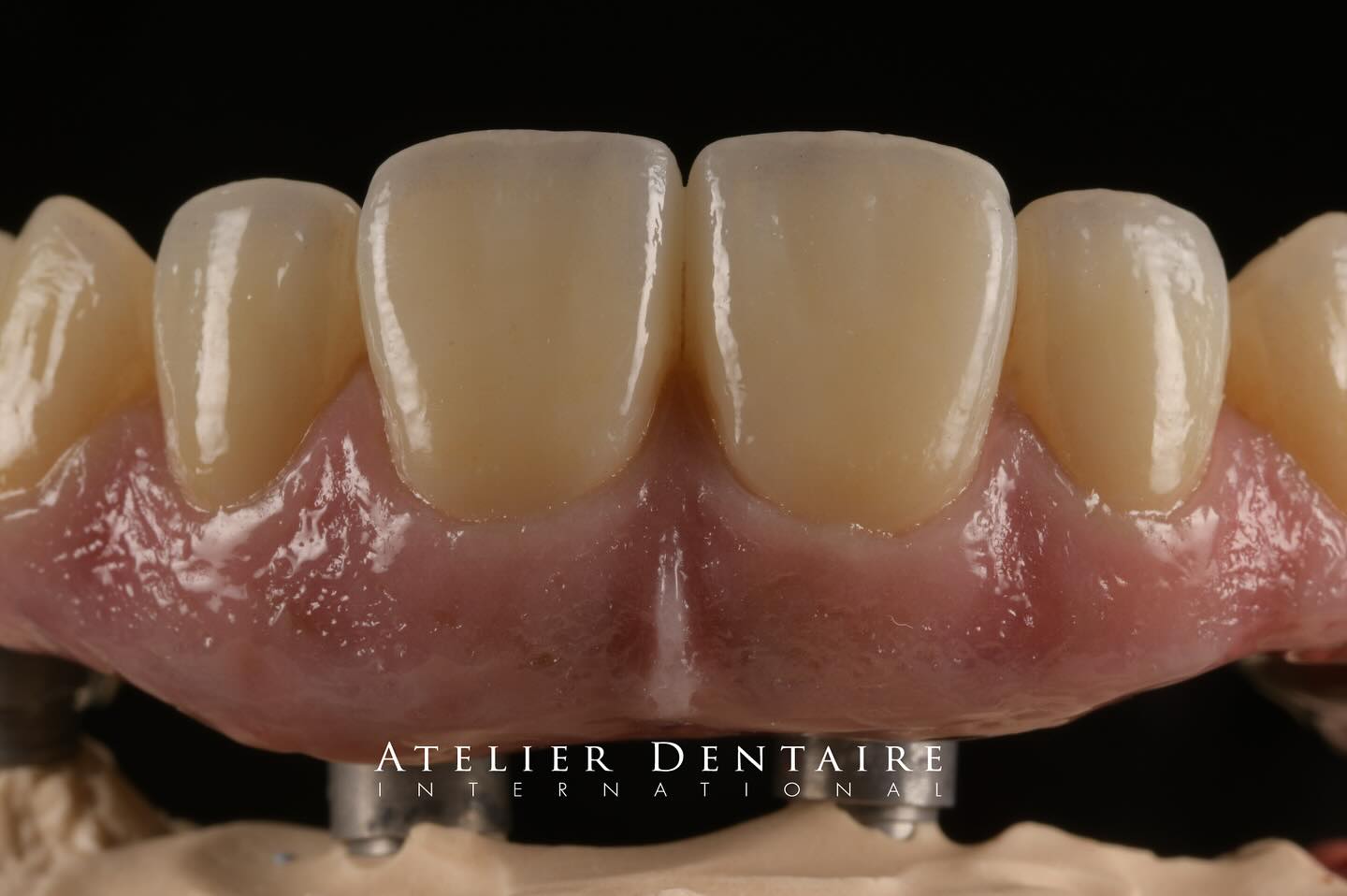 This Pink Was Born from e.max Ceram — Twice Fired, Once Glazed🔥
・
・
・
・
thanks
@ivoclar
@olivier.tric
@atelierdentaire.international
@hirosaka_forestone
#implantbridge
#gingivamakeu
#emax
#fullarchrestoration
#dentalphotographgroup
#静岡県歯科技工所
#歯科技工士
• #gingivalceramics
• #fullarchbridge
• #emaxceram