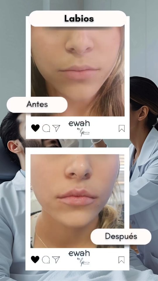 Estas buscando un tratamiento de aumento de Labios Con Acido Hialuronico en Bogotá? Asiste a tu consulta en EWAH By Dra. Lorena Pinzon y logra tus labios naturales soñados.
En EWAH usamos acido hialurónico Coreano marca YVOIRE By LG de la mas alta Calidad asegurando resultados increiblemente naturales.
#AcidoHialuronico #acidohialuronicobogota #botox #rejuvenecimientofacial #botoxbogota #medicinaestetica #radiesse #aumentodelabios #aumentodelabiosconacidohialuronico