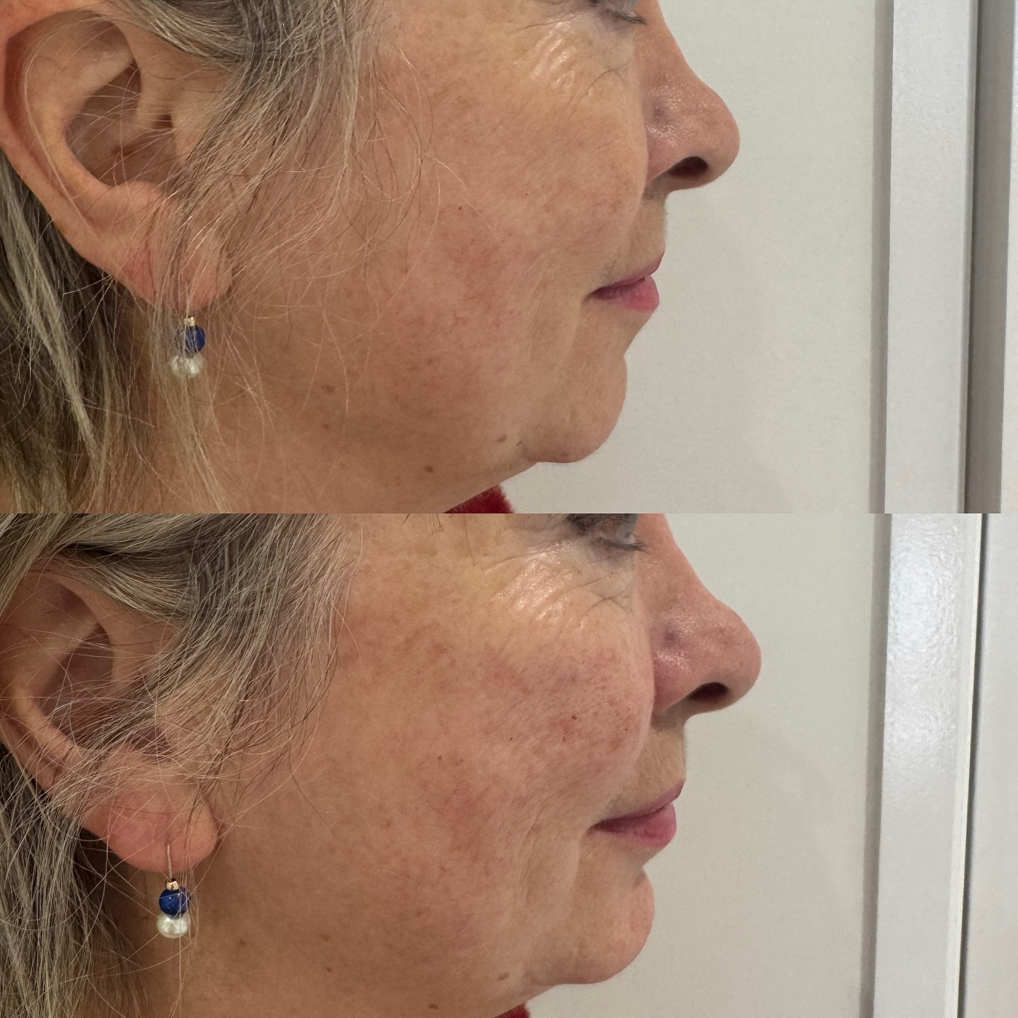 ✨ The art of balance ✨
Sometimes the most beautiful transformations are the most subtle. With a touch of Teoxane RHA4, we enhanced the cheeks for lift and contour, and added gentle chin projection to create perfect facial harmony.
The result? A beautifully balanced profile — soft, natural, and effortlessly refined. 💫
This treatment highlights how strategic filler placement can enhance your natural structure rather than change it. It’s all about proportion, balance, and confidence. This is the beginning of our patients journey and we cannot wait!
💉 Product used: Teoxane RHA4
⏱ Treatment time: ~30 minutes
💎 Downtime: Minimal
✨ Results: Immediate, refined, and long-lasting
Would you like to see your own before & after balance analysis? Send us a DM to book your consultation 💌
#FacialBalancing #ProfilePerfection #TeoxaneRHA4 #CheekFiller #ChinFiller #NaturalResults #AestheticArtistry #SubtleEnhancement #ConfidenceByDesign