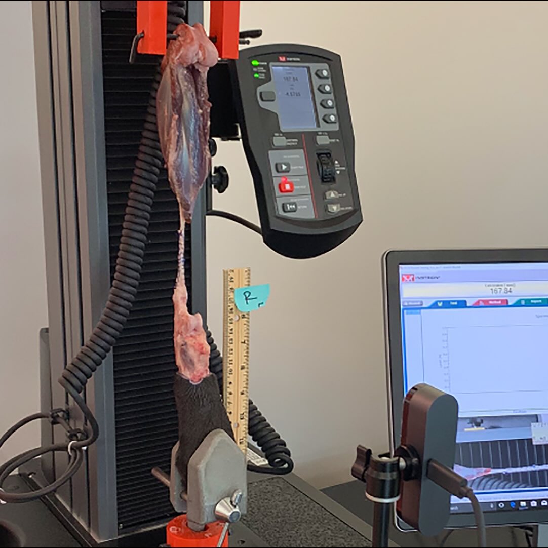 Randomized ex vivo biomechanical study using 42 skeletally mature canine hindlimbs in a calcanean (Achilles) tendon avulsion model. Three calcaneal bone-tunnel anchoring techniques were compared for teno-osseous reattachment with a 3-loop-pulley suture: single transverse tunnel (TT), paired vertical tunnels (VT), and a modified (MT: transverse + two divergent) configuration (n=14/technique). Outcomes included yield, peak and failure loads, stiffness, load to 3 mm gap, and failure mode under uniaxial distraction. TT and VT had higher yield loads than MT (TT vs MT +25%, p=.027; VT vs MT +19.6%, p=.038), but peak load, failure load, stiffness, and gap behavior did not differ among groups.
All three tunnel orientations performed similarly for the clinically meaningful endpoints of peak/failure strength, stiffness, and resistance to 3 mm gapping—suggesting surgeons can choose tunnel orientation based on exposure, patient anatomy, and the need to accommodate adjunct talocrural stabilization (e.g., calcaneo-tibial screw, TESF) rather than expected primary repair strength. Because construct failure was dominated by suture pull-through (≈ 67%) rather than tunnel orientation, attention to suture–tendon purchase, caliber, and possible adjuncts (epitendinous purchase, augmentation) likely matters more than the exact tunnel geometry.
Prior canine work compared suture patterns and augmentations; this study isolates the effect of calcaneal tunnel orientation itself. The finding that orientation minimally impacts global biomechanics (beyond a modest yield-load difference) supports pragmatic, case-by-case tunnel planning and shifts focus toward gap control, immobilization strategy, and augment selection. Reported loads to achieve 3 mm gap (group means ~127–144 N) exceeded some earlier ex vivo reports, likely reflecting model and repair details, but no between-group differences emerged here.