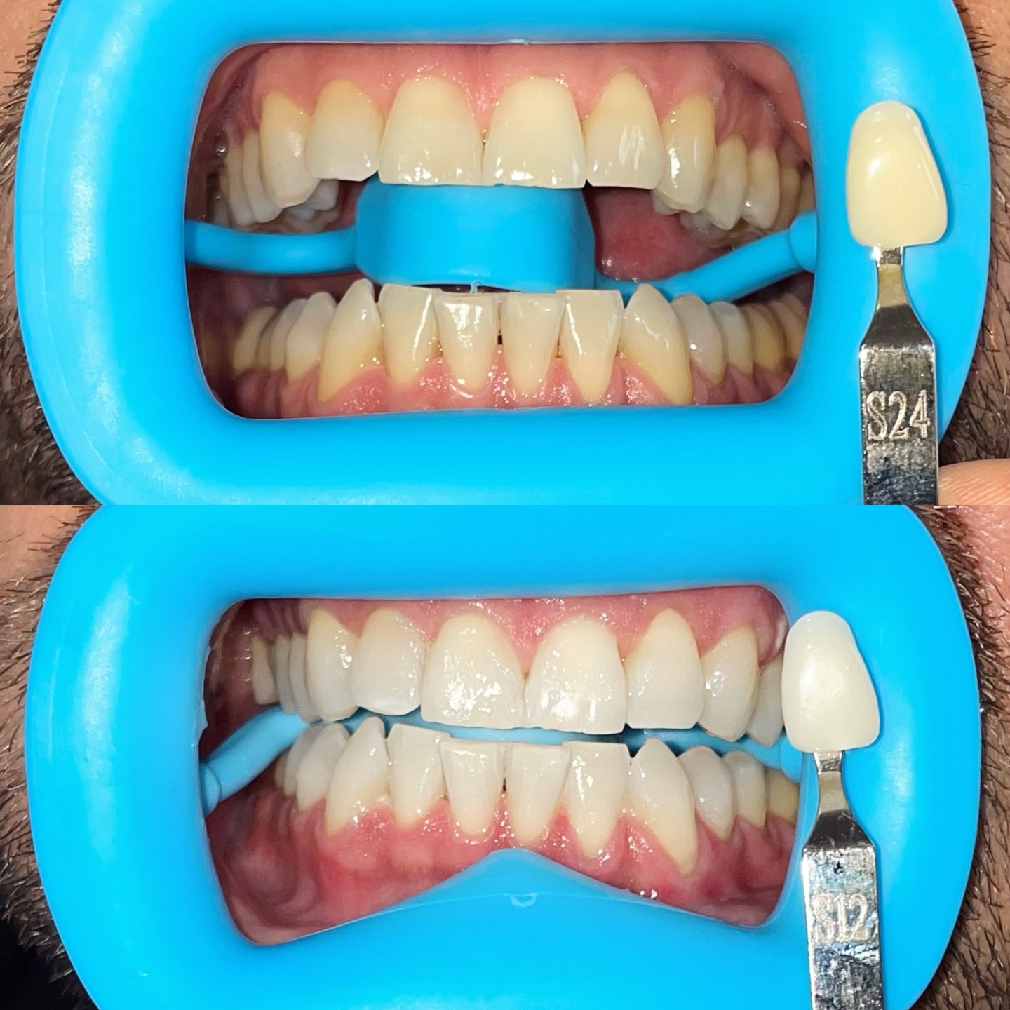 ✨Wanna be GOLDEN?✨
It’s amazing what one session can do — not just for your smile, but for your whole mood💛
I’m here for all the before and afters — let’s get yours🦷
⚡️1 hour appointment
⚡️Lasts 3-6 months
⚡️Gentle on sensitive teeth
👉🏽Booking link in bio
#KacieAndCo #GlowUpSeason #goldenenergy #ConfidenceUpgrade #BeforeAndAfter #teethwhitening #sherwoodoregon