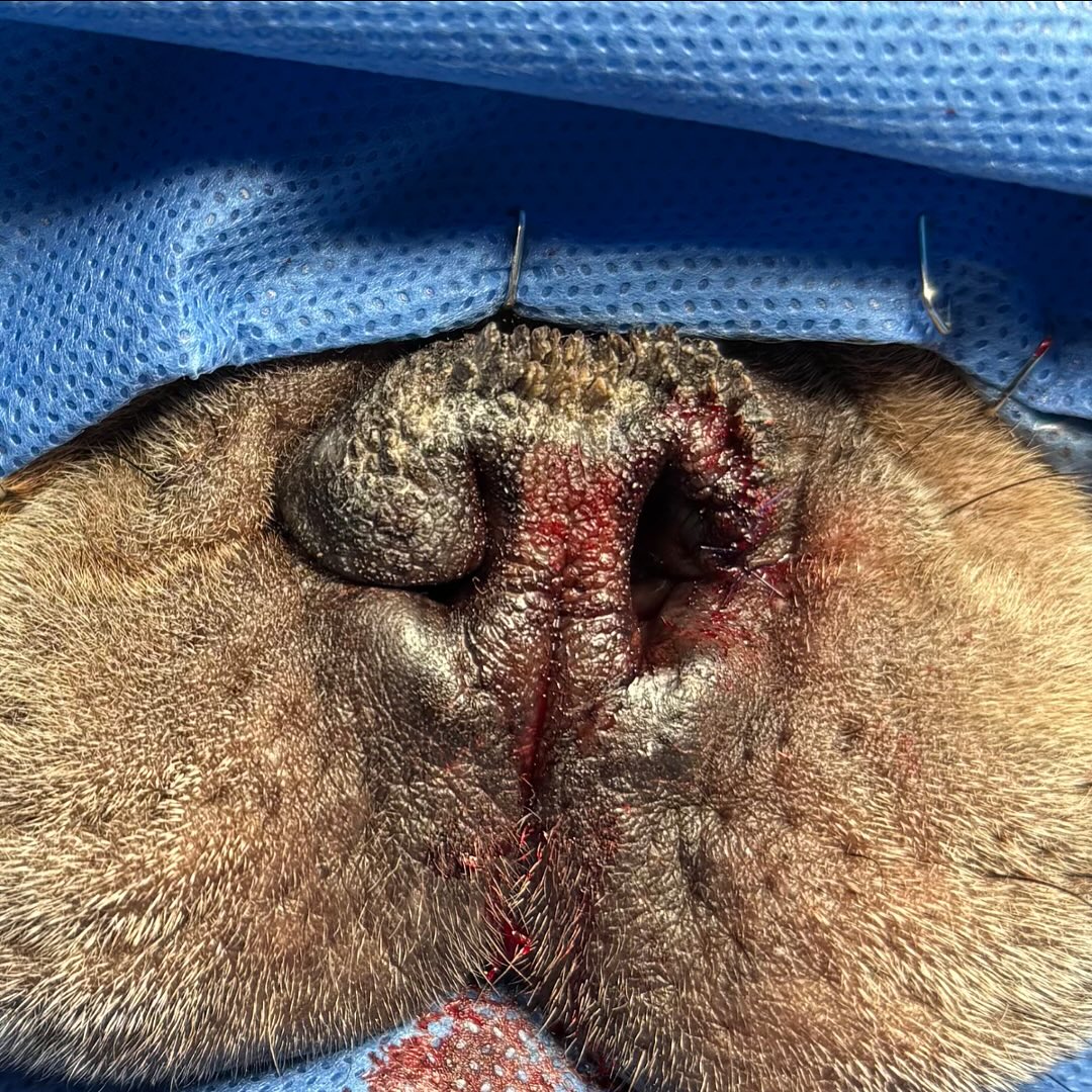 Before (nostril on the left) and after (right) modified vertical wedge resection for severely stenotic nares in a 2-year-old male neutered French Bulldog.
———
The nose contributes 80% of the total airway resistance during inspiration in normal dogs. Poiseuille’s law illustrates that airflow resistance is largely influenced by a decrease in airway radius, with flow being proportional to the radius of the airway to the fourth power.
In silicone models of a French Bulldog with moderately stenotic nares, postoperative CT measures of cross-sectional area (CSA) found that the traditional vertical wedge resection (VW) increased CSA from the nares to the start of the alar fold (slices 1-13), with a mean increase of +26%. Whereas the the modified horizontal wedge (MHW) technique only increased CSA from the nares to about halfway between the nares and alar fold (slices 1-7). Importantly the MHW caused a bottleneck at slices 10-14 (decreased CSA by -7%) due to mid-lateral slit contact, which is clinically very important, as the smallest radius governs total resistance; thus MHW’s mid-vestibular narrowing could offset rostral gains (Franklin et al., Vet Surg 2024).