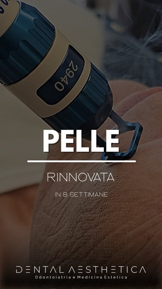 Ringiovanimento viso in 8 settimane?
Perché sceglierlo?
⭐️ Pori, rughe e cicatrici attenuati
⭐️ Texture più uniforme e pelle luminosa
⭐️ Recupero completo in 24/48 ore
Percorso
🗓 3 o 4 sedute distanziate di 30/40 giorni
Cosa puoi aspettarti
☺️ Lieve rossore e micro desquamazione nei primi giorni
🧴 Skincare e fotoprotezione guidata dal nostro team
✨️ Miglioramento evidente già dalla seconda seduta
Limitazioni
⚠️ No in caso di esposizione solare attiva
✋🏻 Trattamento medico: non effettuiamo valutazioni per messaggio né al telefono. Necessaria una prima consulenza.
Per info e prenotazioni:
📍 viale della Grande Muraglia 256 - zona Eur Torrino
📱 375 88 47 069
