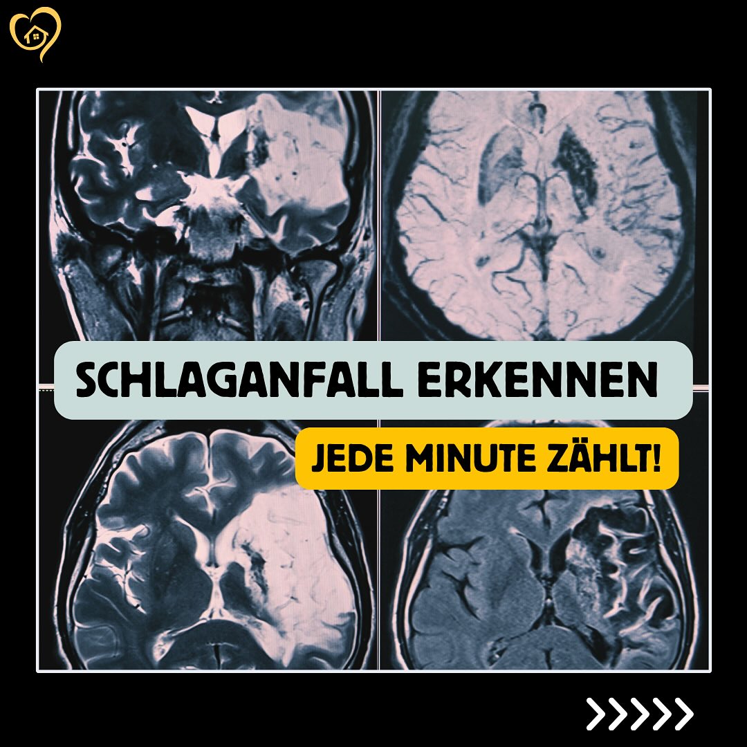 Schlaganfall erkennen-jede Minute zählt!
Ein Schlaganfall kann jeden treffen. Schnelles Handeln ist entscheidend für den Verlauf und rettet Leben!
Mit dem FAST Test erkennst Du Warnzeichen sofort:
Face: hängt ein Mundwinkel?
Arm: sinkt ein Arm ab?
Speech: ist die Sprache verwaschen?
Time: sofort 112 rufen!!!
Jede Sekunde zählt.
Je schneller geholfen wird, desto größer die Chance auf Heilung!
#schlaganfall #erstehilfe #alltagshilfe #fasttest #notfallwissen #lebenretten #erstehilferettetleben #alltagshelden #betreuung #pflegemitherz