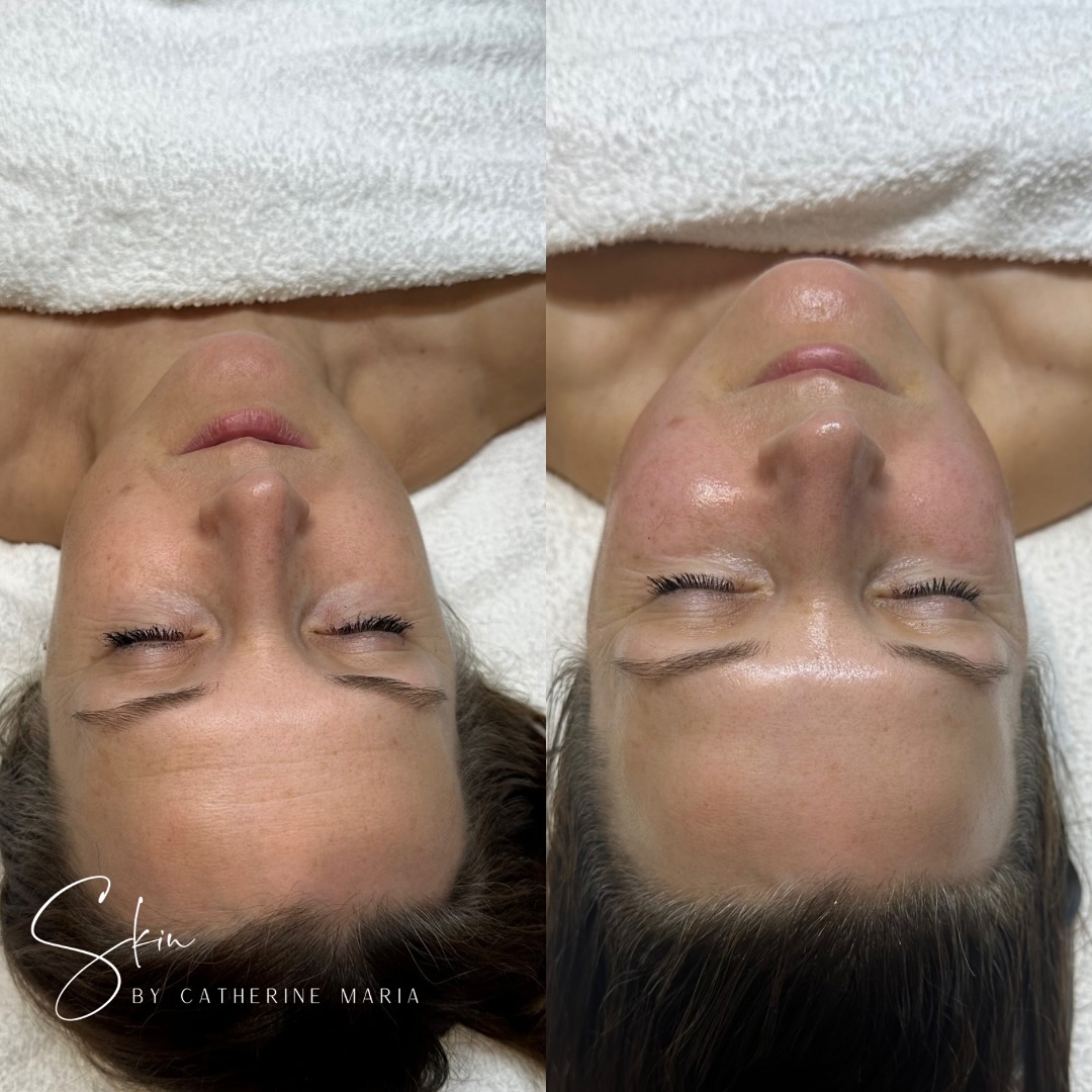 Here’s a beautiful before and after of the Sculpt & Lift Advanced Facial Massage 🤍
Who else can notice a difference? 🥰
If you hold a lot of tension on the face, this one is for you. It’s all about lifting, toning and stimulating circulation and lymphatic drainage.
We used @dermavidualsuk cleansing milk and gel, enzyme peeling mask which uses natural enzymes such as pineapple and papaya enzymes to help loosen and remove the dead skin cells, a bespoke individual mask and finishing products.
It’s always about natural rejuvenation without harsh treatments.
P.S. a new treatment will be launched tomorrow.
🗓️ Book via the link in bio
📍 Aylesbury, Buckinghamshire
📞 07759567391
📩 info@skinbycatherinemaria.com
🌍 www.skinbycatherinemaria.com
#aylesbury #aylesburybusiness #aylesburyvale #aylesburymums #aylesburyfacials #aylesburybeauty #aylesburybeautysalon #aylesburytown #buckinghamshire #buckinghamshirebusiness #buckinghamshirewedding #buckinghamshiremums #buckinghamshirelife #buckinghamshirebeauty #fairfordleys #berryfieldsaylesbury #kingsbrookaylesbury #westonturville #stokemandeville #wendover #astonclinton #waddesdon #haddenham #longcrendon #facialmassages #facialmassage