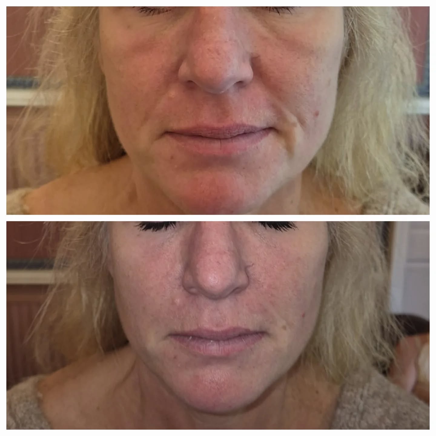 No nasolabial filler was used in this transformation — the results were achieved solely through expertly placed cheek filler. As we age, we naturally lose volume in the midface, which can cause the cheeks to appear flatter, the under-eye area to look more tired or hollow, and the nasolabial lines (smile lines) to deepen.
By restoring volume in the cheeks, we’re able to lift and support the midface, soften the appearance of nasolabial folds, and improve the contour under the eyes — all without directly treating those lines. This approach focuses on cause rather than effect, giving a more natural and harmonious result.
The outcome is a refreshed, lifted, and youthful appearance — without changing the natural shape or character of the face.