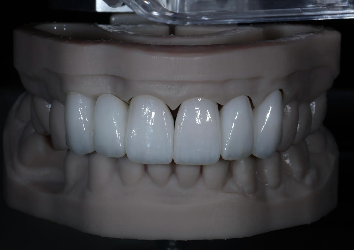 6 Anterior Zirconia Crowns