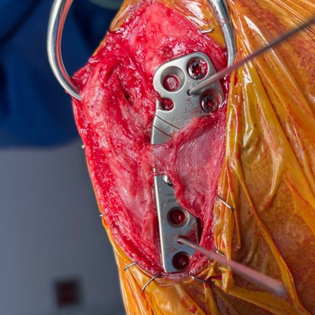 Pes-sparing TPLO in a 6-year-old FS Husky Mix with a complete CCL tear with a 3.5mm standard Arthrex TPLO plate. Interfragmentary compression was achieved via the eccentric DC hole, with locking screws in H1 and H3, and pointed bone reduction forceps engaging the caudal aspect of the proximal bone fragment and the cranial aspect of the tibial crest.
———
Preserving the attachment of the pes anserinus (keeping the tendons of the sartorius, gracilis, and semitendinosus muscles intact) has shown clinical benefits in human high tibial osteotomy, a procedure similar to the TPLO
The pes anserinus acts like a natural strap that pulls in two directions: backward (blue) and upward (green).
In humans, avoiding pes release has been associated with faster bone healing (~4 vs ~5 months) and improved knee function during early rehabilitation, with equivalent 1-year outcomes compared to cases where the tendons were transected.