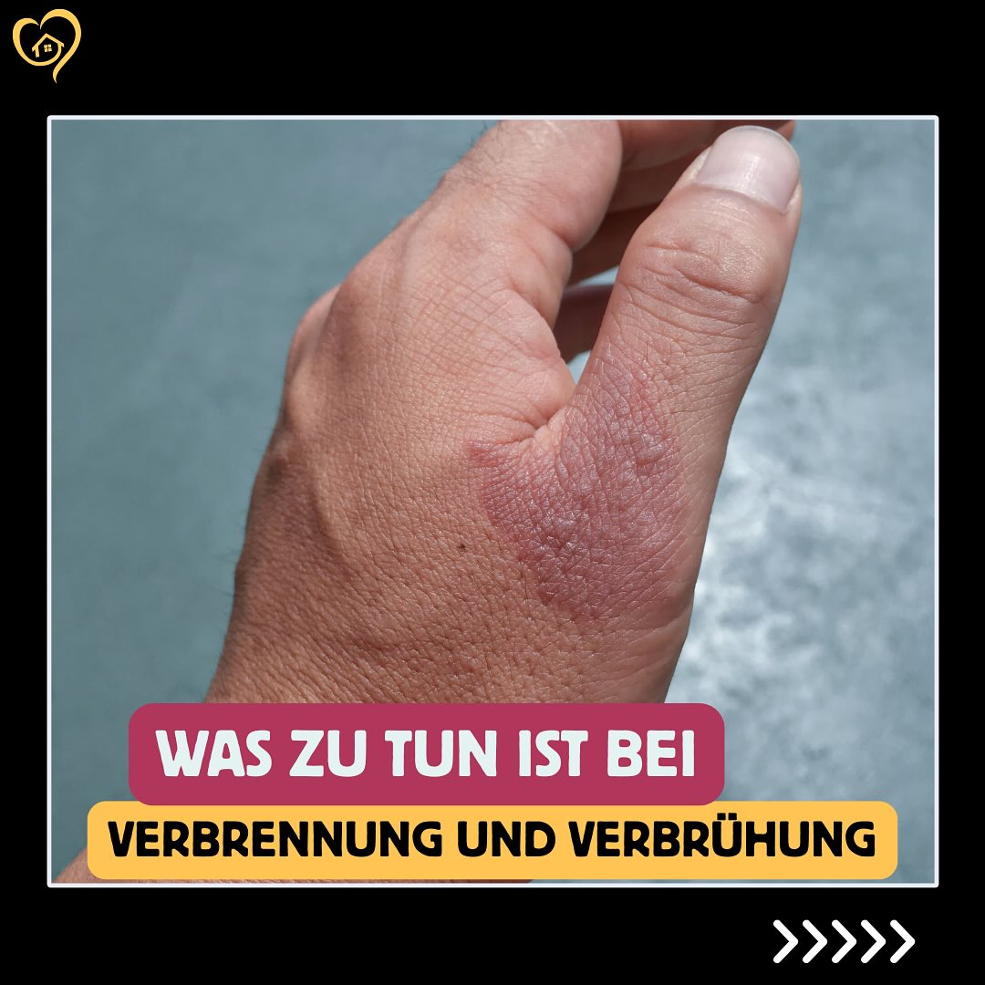 Erste Hilfe bei Verbrennungen❗️
Kühlen, schützen, Hilfe holen!
Verbrannte Haut sofort mit lauwarmem Wasser kühlen (mind. 20 Minuten), steril abdecken und im Zweifel zum Arzt oder den Notruf wählen.
#erstehilfe #verbrennung #schnellhandeln #lebensretter #alltagshilfe #seniorenbetreuung #pflegemitherz