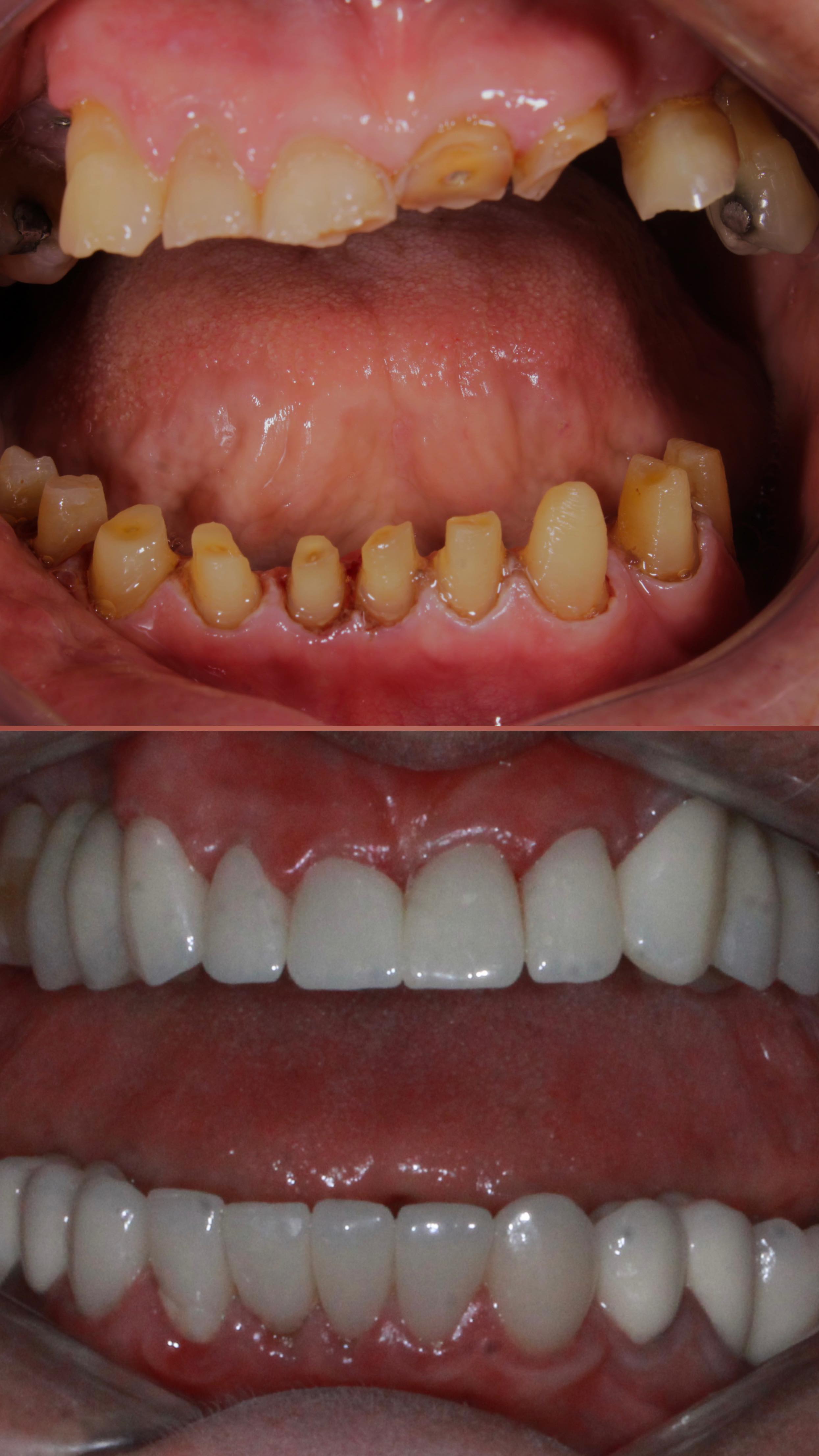 #OdontologiaEstética #Zircônia #zibase #ImplantesDentários #PróteseSobreImplante #Dentista#facetas #lentes #implantes #saudebucal #odontologia #tratamentoodontologico #dente #estetica #anapolis #implantezirconia #odontologiabiológica #odontolgiaintegral #odontologiabiologicaeintegrativa #dentistaanapolis #scannerintraoral