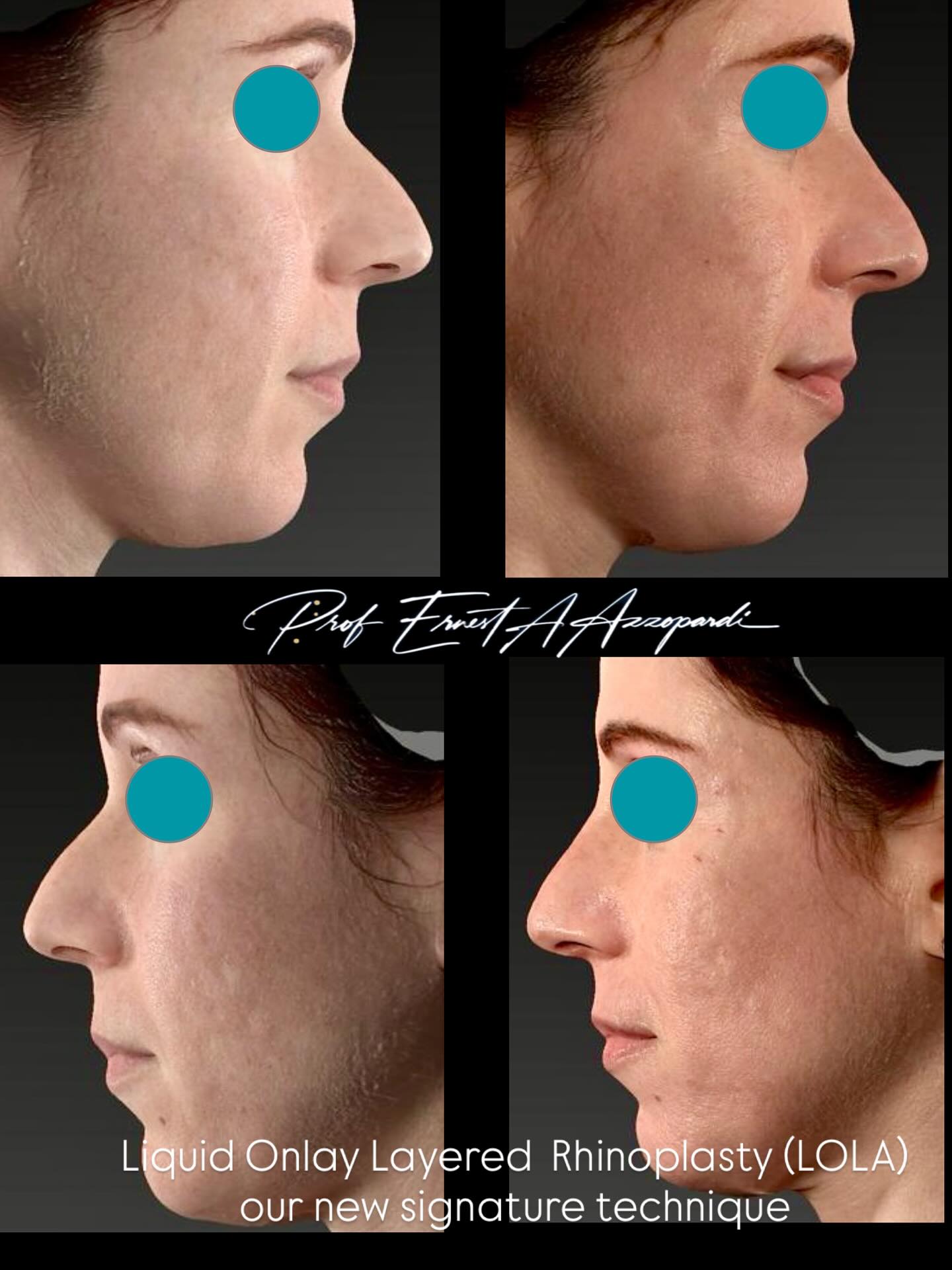 Showcasing typical results with Layered Onlay Liquid Augmentation (LoLA ) rhinoplasty.
Before and After
3D vectors scan
3D subtraction scan
So grateful to our lovely patient for even allowing us to share a natural shot.
Experience -compassion - expertise
🛜 www.skinsurgeon.eu
📧info@skinsurgeon.eu
#londonwelbeckhospital #rhinoplasty #consultantplasticsurgeon #nosejoblondon #remedieshealthandbeauty #skinsurgeon
