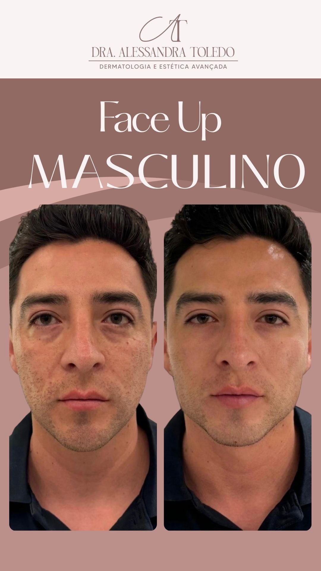 Resultados reais exigem estratégia, técnica e investimento.
No Face Up Masculino, o foco é estrutura, firmeza e definição, e para isso, usamos a quantidade ideal de produto para transformar, sem exageros.
Meu compromisso não é com o menor preço.
É com o resultado. 💪
👉 Quer alcançar esse nível de transformação?
Comente “EU QUERO” e descubra o que o Face Up Masculino pode fazer por você!
#FaceUp #HarmonizaçãoFacialMasculina #RostoMarcado #DefiniçãoFacial #EstéticaAvançada