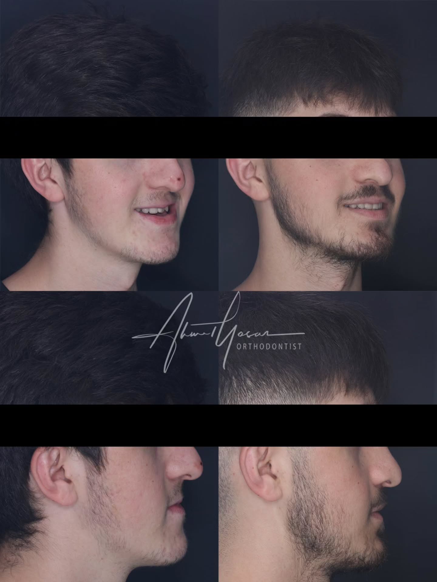 Çift çene amelyatı / Orthognathic surgery.
.
Our clinic is authorized by the Ministry of Health of the Republic of Türkiye for International Health Tourism. All patients have been informed and have provided consent for the use of their photographs on our social media platforms. All content shared on social media is intended to inform patients about procedures and should not be perceived as advertising. Outcomes of any surgical or interventional treatment may vary from person to person. It is recommended to consult your physician for detailed information before undergoing any procedure.
.
.
#ortodonti #ortodontist #bursa #bursaortodonti #bursaortodontist #bursaortodontiuzmanı #orthodontics #braces #teltedavisi #dişteli #orthognathicsurgery #invisalign #diş #şeffafplak #lingualortodonti #dişteli #çeneameliyatı #selfligating #kapaklıbraket #gülüştasarımı #dişhekimi #dentistry #photography #estetik #dentalart #ahmetyasar #drahmetyasar