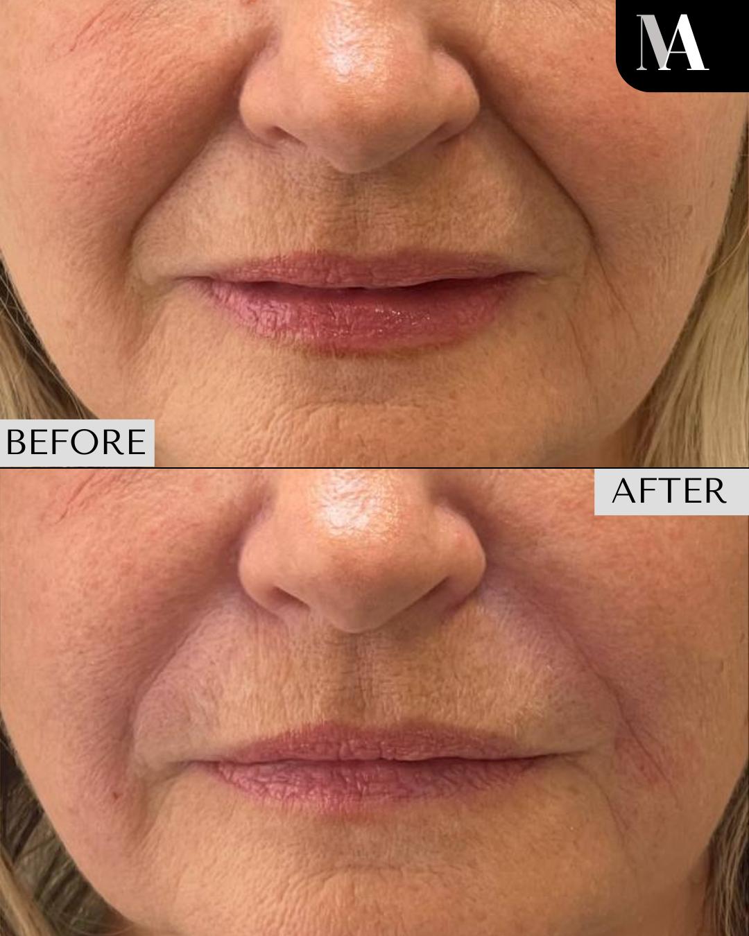 This patientโs transformation showcases how precise treatment of the nasolabial folds and marionette lines can restore youthful volume and balance while maintaining a natural look.
At MedAesthetic Academy, we teach medical professionals how to safely and effectively deliver results like this through our doctor-led, CPD-accredited courses.
โ๏ธ Hands-on training with live models
โ๏ธ Doctor-led mentorship from award-nominated clinicians like Dr Harry James
โ๏ธ Located on Harley Street โ the UKโs centre of medical aesthetics
โ๏ธ Courses designed for doctors, dentists, nurses and clinical pharmacists seeking a career in aesthetics
๐ฌ Take the first step towards building a rewarding, flexible career in medical aesthetics:
WhatsApp: 0800 772 3304
๐ง Email: contact@medaestheticacademy.co.uk
๐ www.medaestheticacademy.co.uk
#MedaestheticAcademy #AestheticTraining #MedicalAesthetics #DoctorLedEducation #InjectablesTraining #CPDAccredited #AestheticsCourse #Aesthetics #HarleyStreet