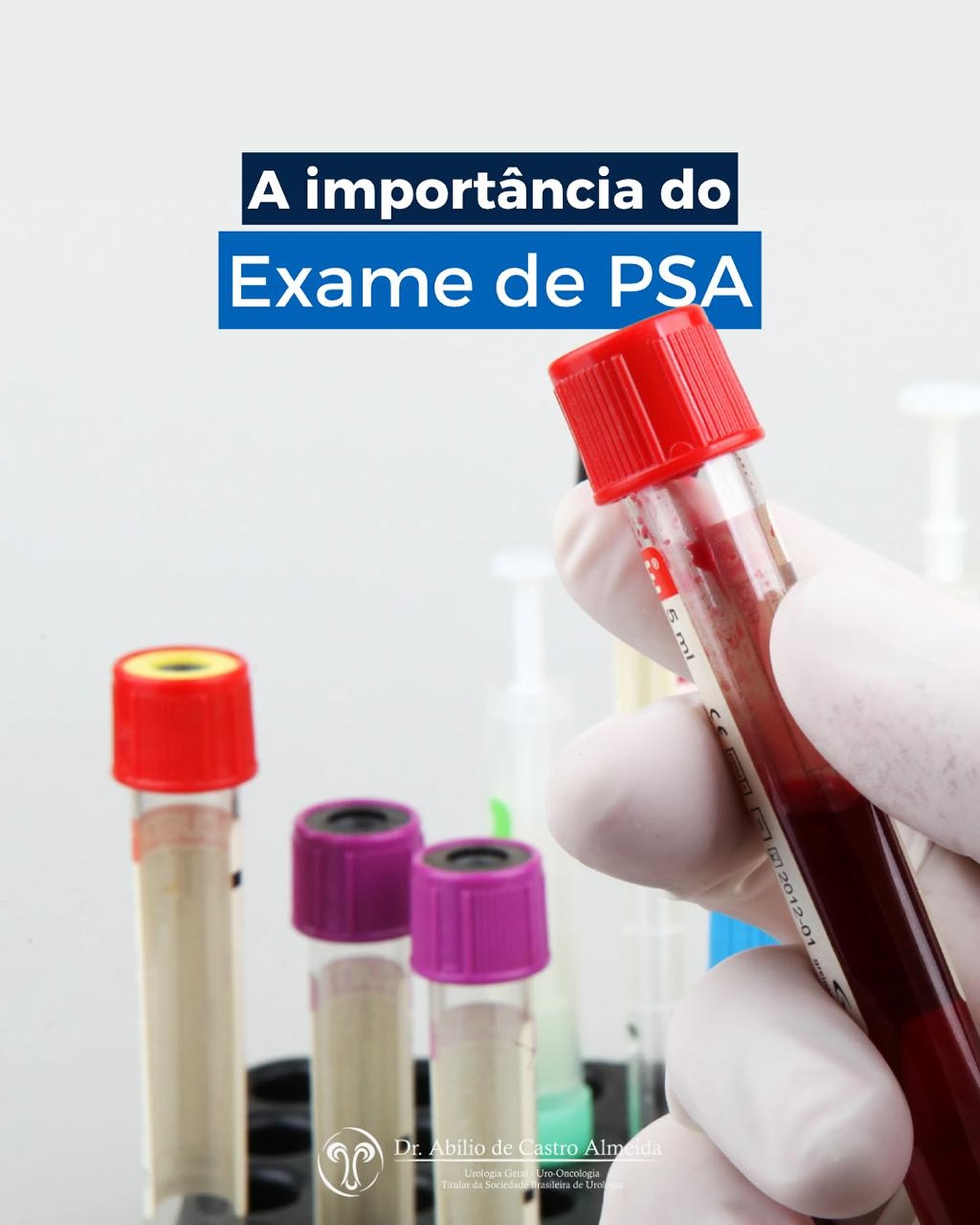 🧪 A importância do exame de PSA
O exame de PSA (Antígeno Prostático Específico) é um exame de sangue simples, mas extremamente importante para a detecção precoce de doenças da próstata, incluindo o câncer de próstata. ⚠️
✅ Ajuda na identificação de alterações antes do surgimento dos sintomas
✅ Aumenta as chances de um tratamento eficaz
✅ Faz parte da rotina de prevenção urológica, especialmente a partir dos 50 anos — ou antes, em casos de fatores de risco.
⚠️ Importante: o exame de PSA não substitui a consulta com o urologista nem o exame de toque retal, que continua sendo fundamental para uma avaliação completa da saúde da próstata.
📅 Consultas regulares e exames preventivos salvam vidas!
#PSA #Urologia #SaúdeDoHomem #Prevenção #CâncerDePróstata #Urologista #ToqueRetal #ExamesDeRotina #SaúdeMasculina