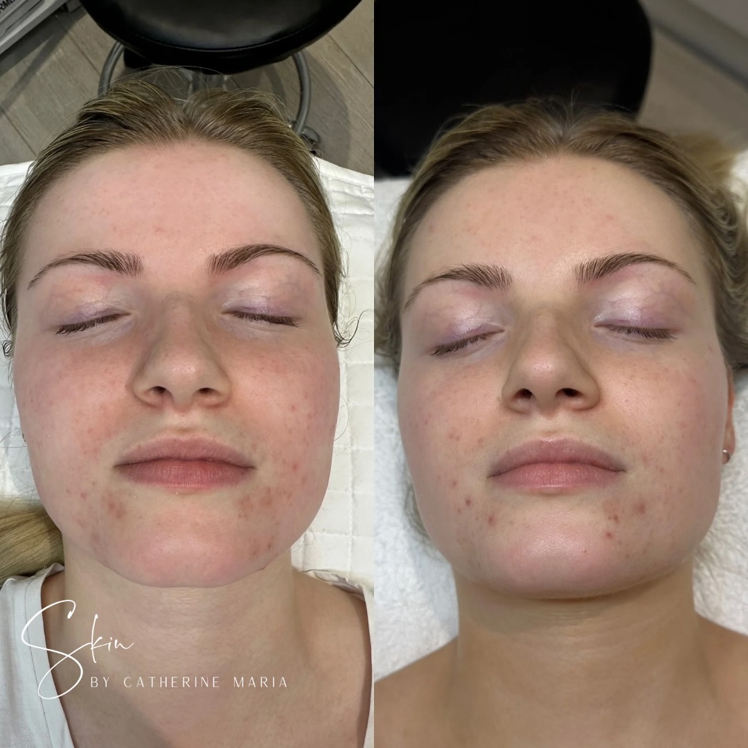 Two weeks. One simple change. Big difference.
We switched my client’s cleanser to one that actually supports her skin type and the results speak for themselves. Her skin is noticeably calmer, clearer, and more balanced. We still have more work to do, both holistically and topically, but this is an amazing start.
My client also just had her first SQT bio microneedling (swipe right to see) nourish and hydrate to target her redness, sensitivity and repair her skin barrier. No harsh treatments, no acids, no chemicals.
If you’re struggling with your skin and feel overwhelmed, pop me a message.
🗓️ Book via the link in bio
📍 Aylesbury, Buckinghamshire
📞 07759567391
📩 info@skinbycatherinemaria.com
🌍 www.skinbycatherinemaria.com
#aylesbury #aylesburybusiness #aylesburyvale #aylesburymums #aylesburyfacials #aylesburybeauty #aylesburybeautysalon #aylesburytown #buckinghamshire #buckinghamshirebusiness #buckinghamshirewedding #buckinghamshiremums #buckinghamshirelife #buckinghamshirebeauty #fairfordleys #berryfieldsaylesbury #kingsbrookaylesbury #westonturville #stokemandeville #wendover #astonclinton #waddesdon #haddenham #longcrendon