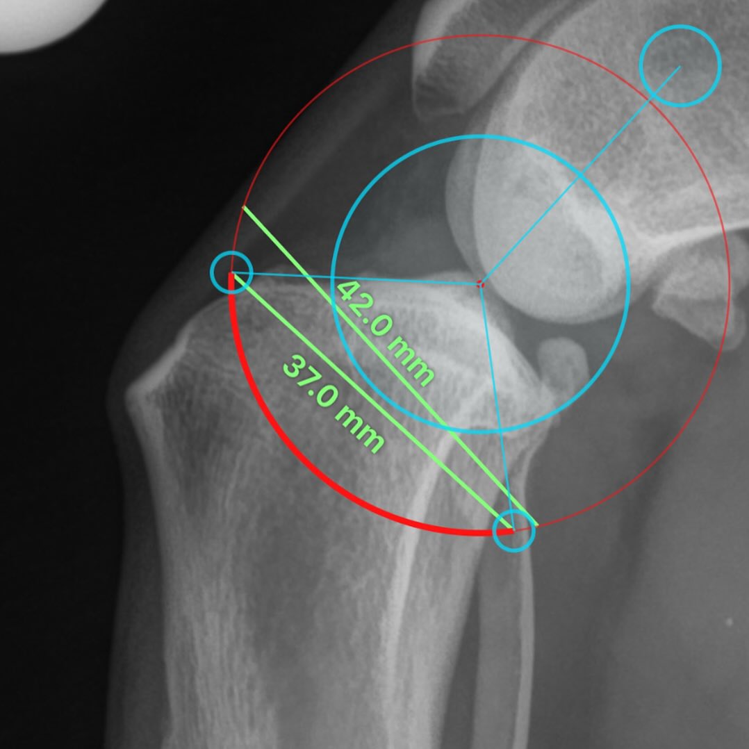 Not all TPLO blades are the same. Even when blades have the same radius (arc of curvature), their chord length (the straight line the connects the arc’s two endpoints) can differ. E.g. the diameter is also considered to be a chord, which passes through the center of the circle.
———
We have personally measured the chord length for every TPLO blade we use, a detail that is not published on the manufacturer websites and one that most surgeons do not consider.
This matters because a blade may technically match the planned radius but still be too large to seat correctly within the dog’s proximal tibia. The patellar ligament (dorsally) and the gastrocnemius muscle (caudally) set strict anatomic limits. If the blade’s chord length overshoots those limits, it forces an intra-operative change of blade size.
Having to switch blades mid-surgery undermines the accuracy of pre-surgical planning and may reduce the precision of the osteotomy cut. Pre-operative knowledge of both arc radius and chord length is essential to select the correct TPLO blade and avoid this problem.