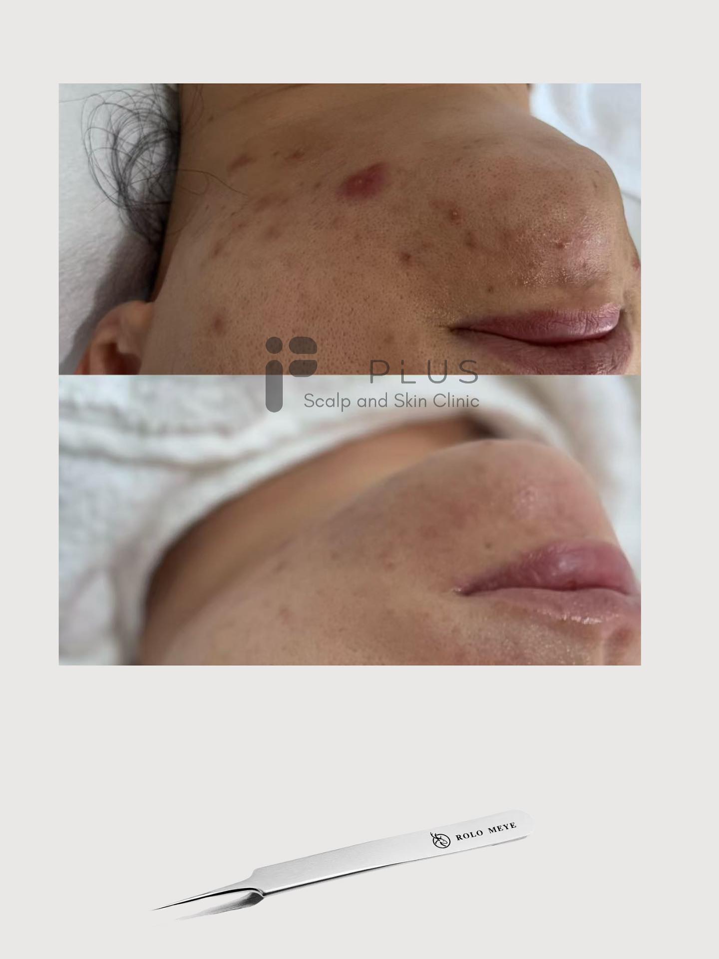 Constant chin breakouts, redness, and sensitivity — finally under control 💆♀️
Our Reactivation + Cell Tweezer treatment helps calm inflammation, repair the barrier, and rebalance oil flow.
✨ Smooth, clear, and stable skin again.
#PlusScalpAndSkin #MalvernSkinClinic #ChinAcne #AcneTreatmentMelbourne #BarrierRepair #ReactivationFacial