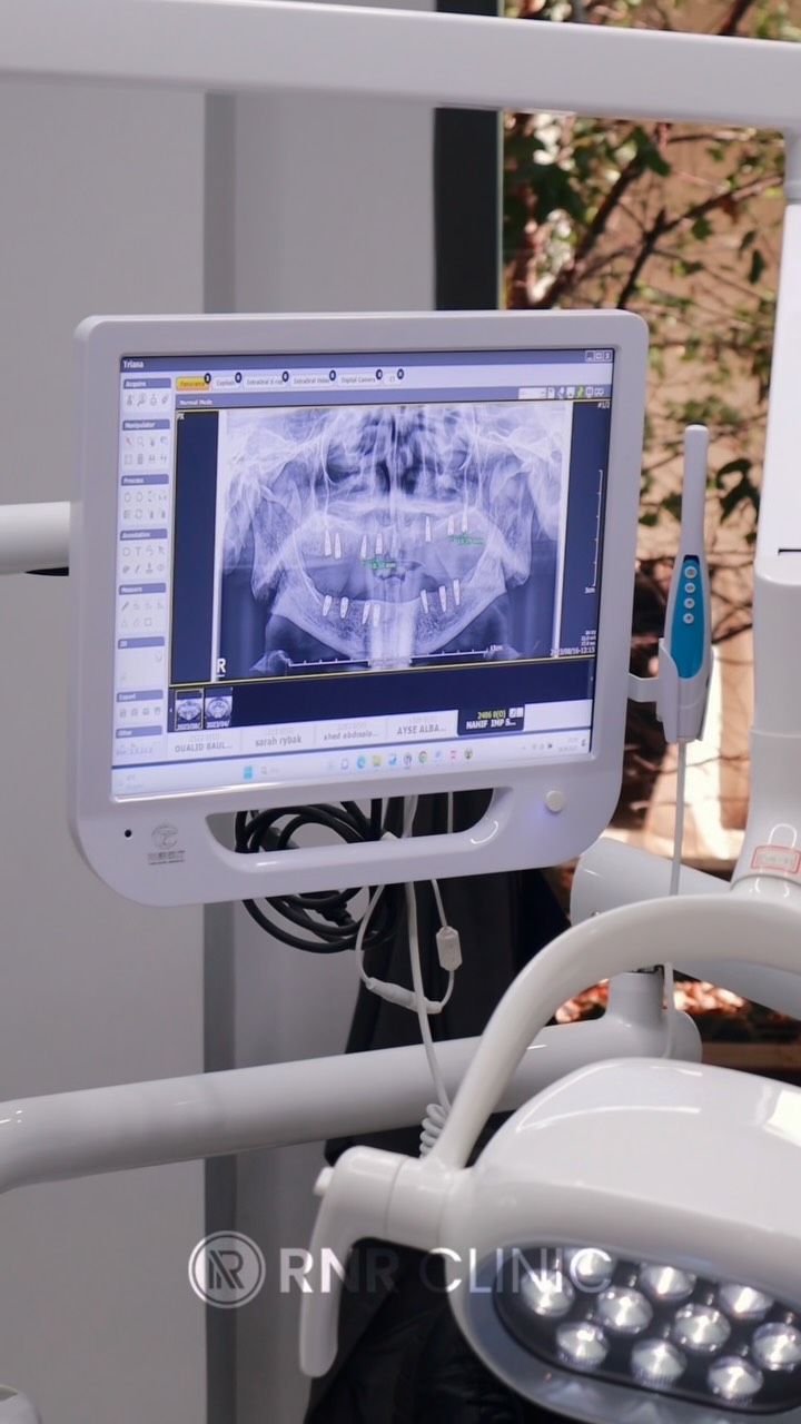 Lassen Sie sich von Ihrem Traumlächeln inspirieren!
Jetzt kostenlose Beratung sichern – inklusive individuellem Angebot! 💫
📍 In Istanbul bei RNR Clinic Turkey – Experten für ästhetische Zahnbehandlungen.
#rnrclinicturkey #dentalaesthetics #smilemakeover #zahnästhetik #hollywoodsmile #istanbulclinic #zahnbehandlung #perfectsmile #dentalcare #smiletransformations #fyp #dental #international #deutschland