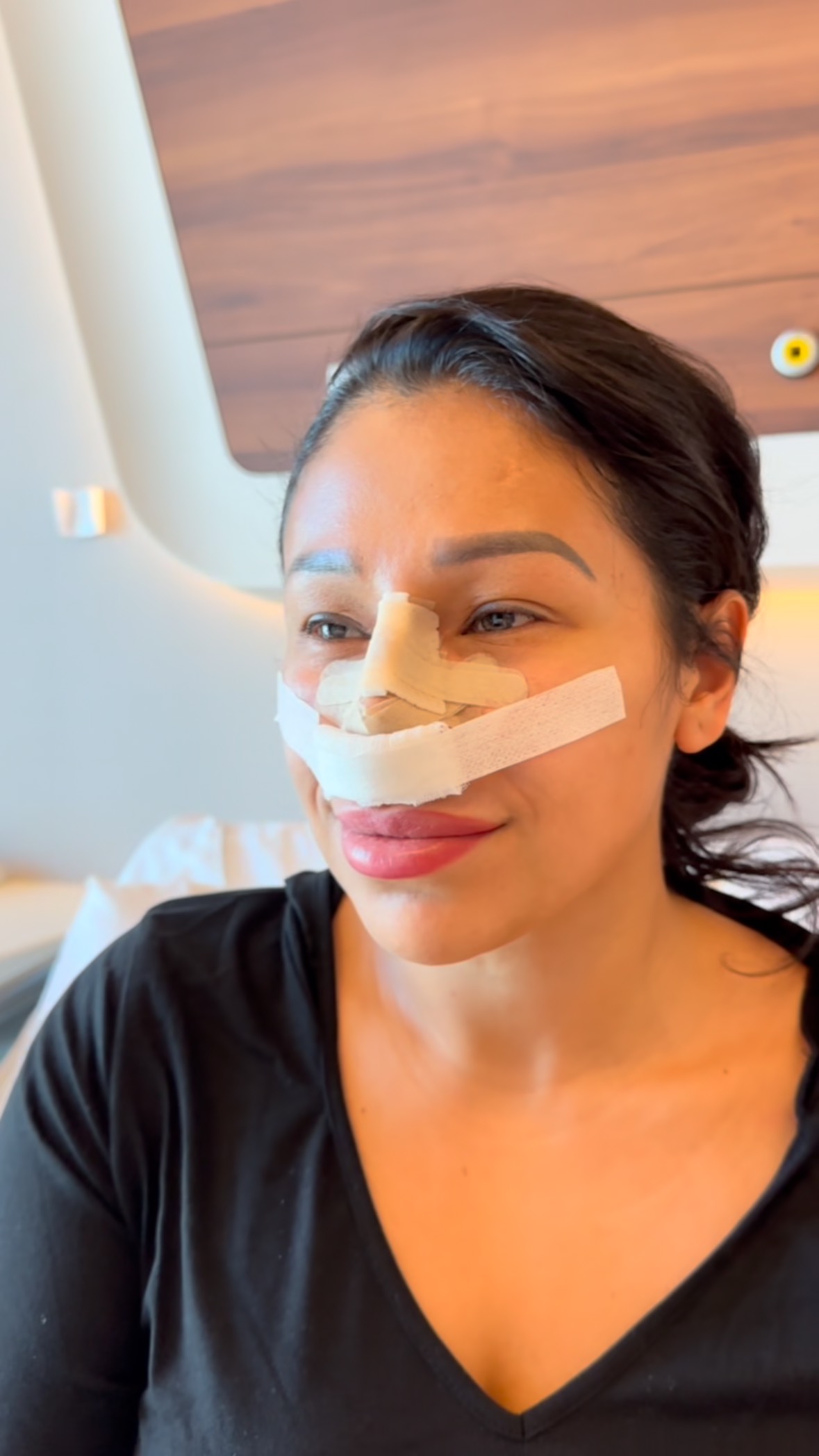 the day after rhinoplasty⭐️