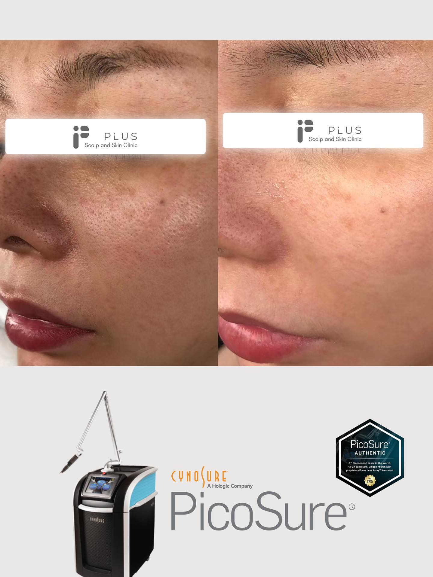 📌 Dermal Pigmentation
🙋♀️Concern: Uneven tone, deep pigmentation, and weak skin barrier.
⚙️Treatment: Started with hydration and barrier repair, then one session of PicoSure 755nm to target dermal pigment.
📍Result: Brighter, smoother skin with lighter spots — glow restored after just one treatment ✨
#skincare #picosure #picolaser #pigmentremoval #pigment #sundamage #spf #sunspot #melasma #skinbarrier #skinrepair #skintreatment #laser