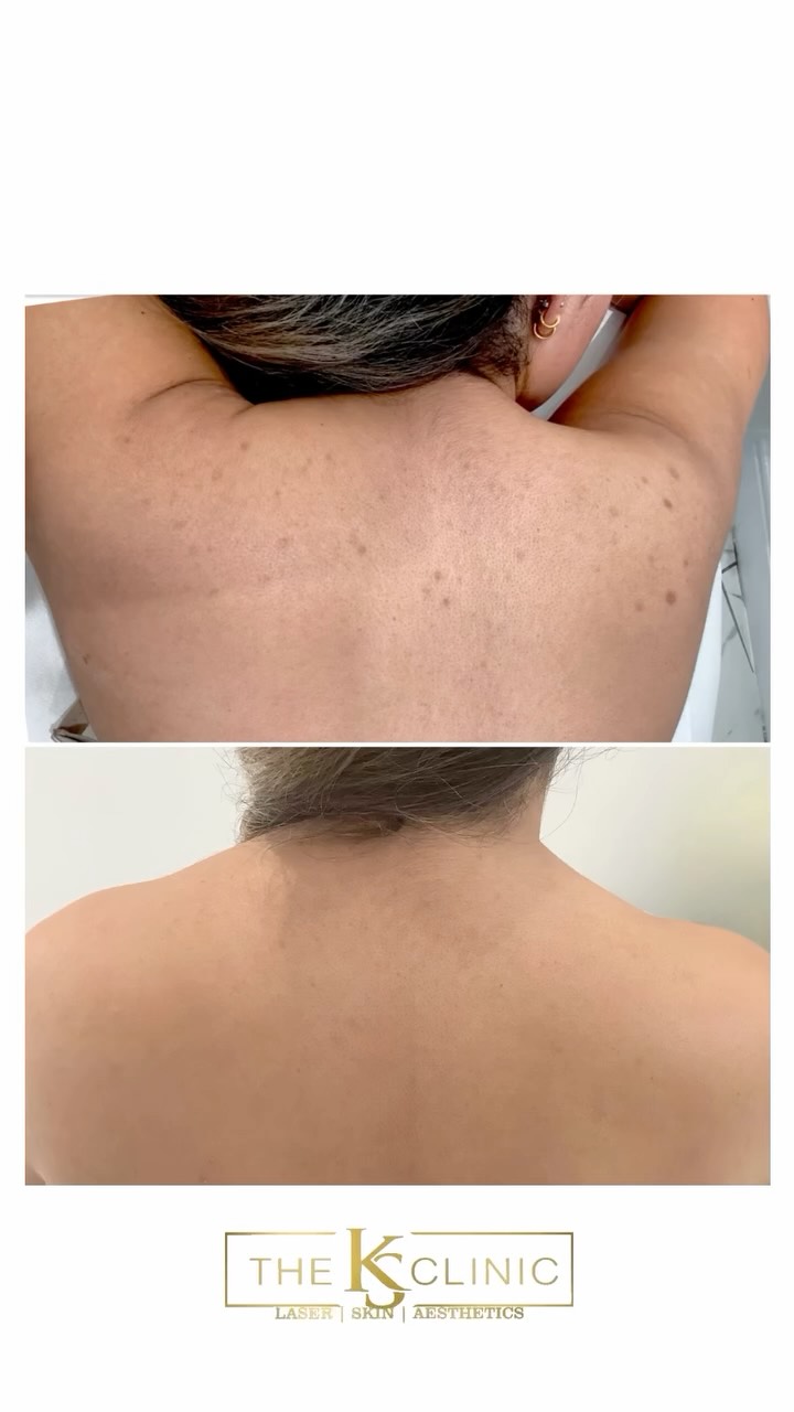 Hyperpigmentation treatment for your back.
Our client had an occasion coming up where she wanted to wear a low cut in the back but didn’t have the confidence due to her spot marks.
After choosing us to carry out our hyperpigmentation treatment, the results speak for themselves and our client feels more comfortable in her own skin.
(Client Process: consultation, a course of 3 of our depigmentation chemical treatments, carried out every 3 weeks along with strong medical grade aftercare cream.)
If you have pigmentation that is effecting your confidence, we can help with our award winning depigmentation treatment package.
Your skin transformation is waiting for you @ The KS Clinic
We look forward to seeing you soon.
@theksclinic #backfacial #hyperpigmentation #hyperpigmentationtreatment #scars #oldbury #sandwell #birmingham