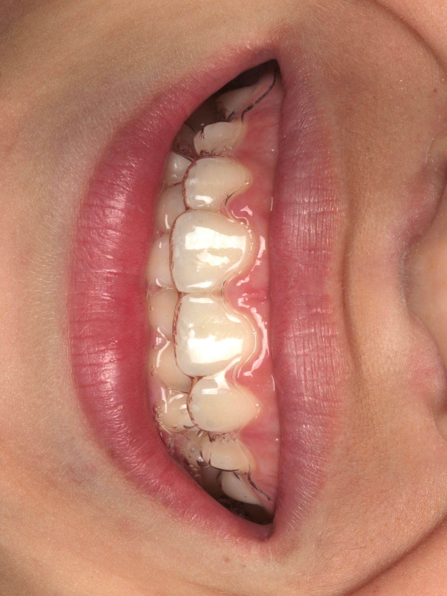 Um sorriso de criança sendo alinhado com alinhadores invisíveis, porque a estética também conta quando o assunto é cuidar dos pequenos 💙
CLINICA PATO | Há 50 anos transformando sorrisos e cuidando de famílias