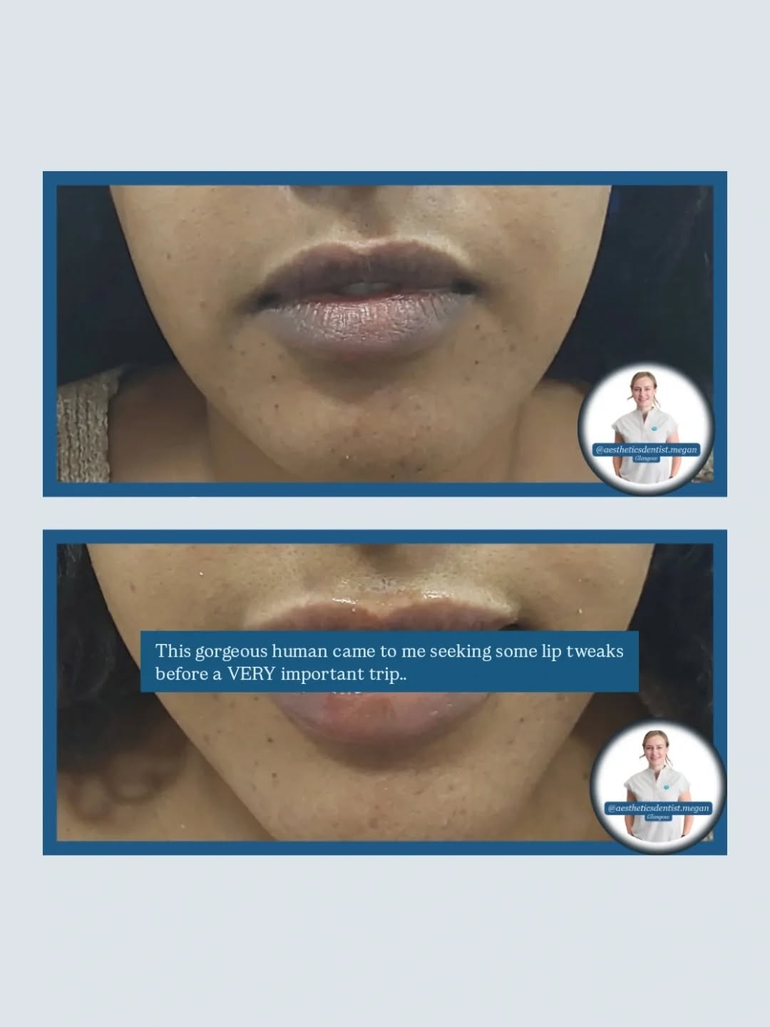 Had to share this gorgeous case! A little bit of my thought process and how I will always listen and align with your goals. (SWIPE through all 6!)
Megan, dentist led aesthetics in Glasgow