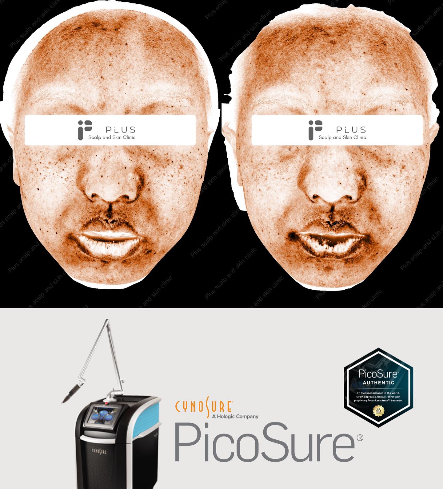 🎯Freckles & Sunspots
⚙️Stubborn freckles and sunspots treated with PicoSure 755nm Focus — safer, precise, and effective for superficial pigmentation.
✨ After 2 sessions: brighter, more even skin tone and reduced freckles.
#PlusScalpAndSkin #MalvernSkinClinic #picosure #PigmentationRemoval #FrecklesTreatment #MelbourneBeauty #GlowingSkin#picolaser #melasma #sunspots #freckles #sundamage #spf #skincare