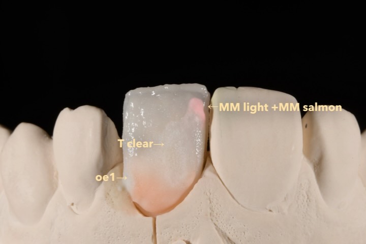 I like e.max Ceram😊
I’ve also included the fabrication process and an intraoral video taken when the crown was cemented.
明度がかなり高いケースだった為
マティスで出たレシピは使用せず製作してます。
デジタルトライインは使用しました👍
製作過程と口腔内動画も載せてます。
参考になれば嬉しいです😆
フレーム・UNC BL1
陶材・e.max ceram
・
・
・
・
・
thanks
@ivoclar
@hirosaka_forestone
@atelierdentaire.international
@olivier.tric
#toothologyst #dentaltechnician #dentallab #dentistry #smile #dentalphotography#teeth #morphology #layering #zirconiacrown#emaxceram #ivoclar#prosthodontics #三島市歯科医院#trios#odontologia #stomatolog #zahnarztl#dentalphotography #dentist#стоматология#Dişhekimi#protetikazuba#singlecentral#optishade#ジルコニア