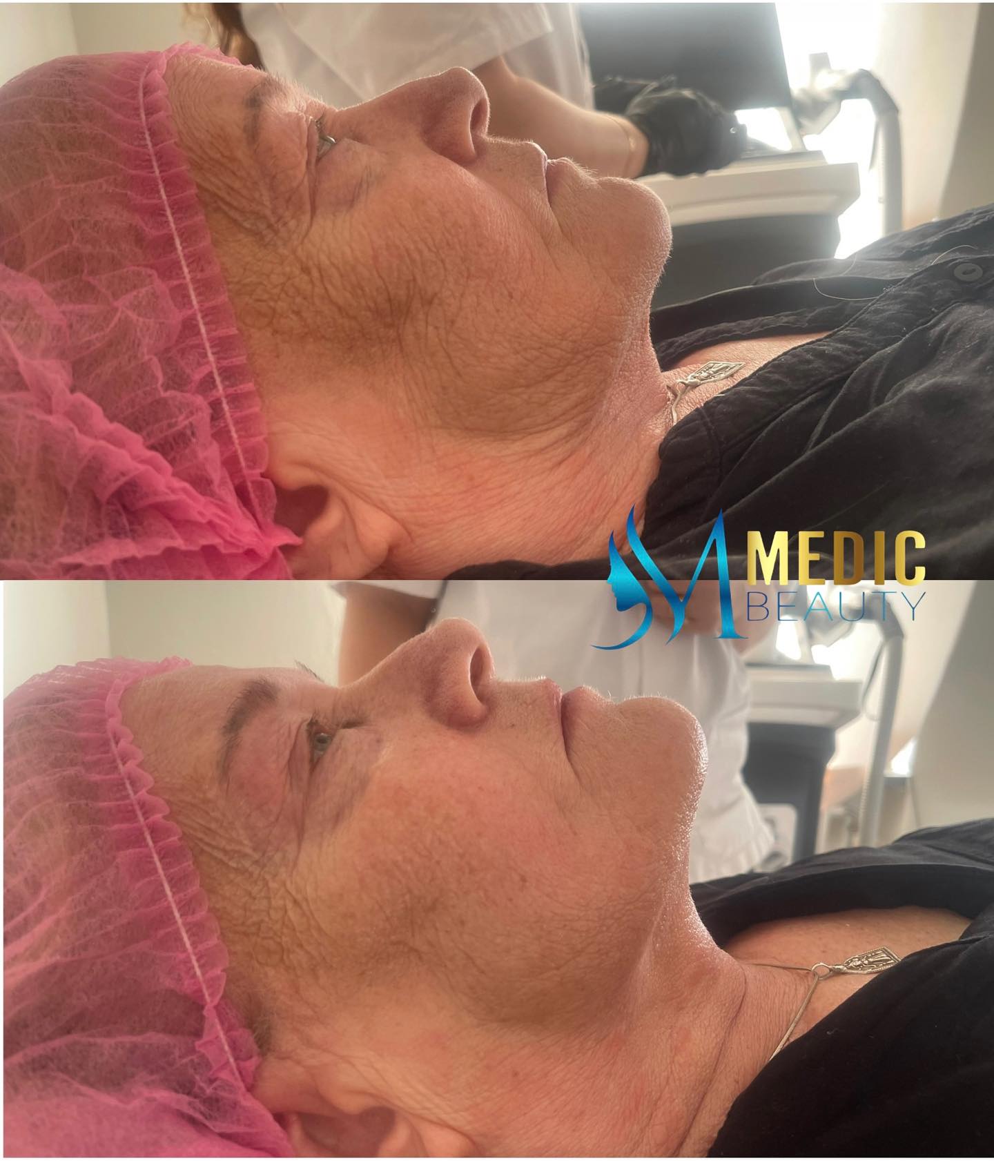 Detta efter första behandlingen med HIFU😍🪄mer än så tänker jag inte skriva och låter bilden tala för sig själv ✨
#boråsstad #skönhetborås #hifuborås #hifu