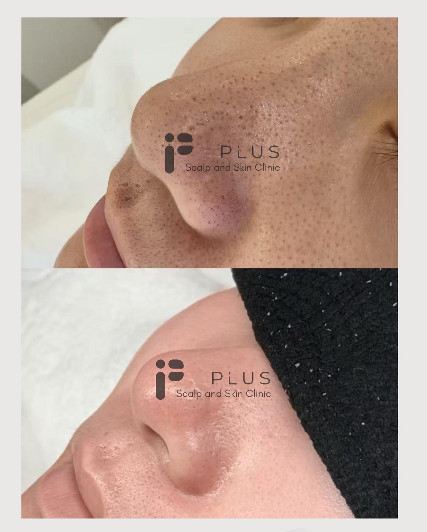 🌿 Blackheads don’t stand a chance.
Our Cell Tweezer lifts impurities gently — no squeezing, no redness, just healthy skin. 🌿
#blackhead #pore #largepore #deepcleanse #facial #acne #melbourne #malvern