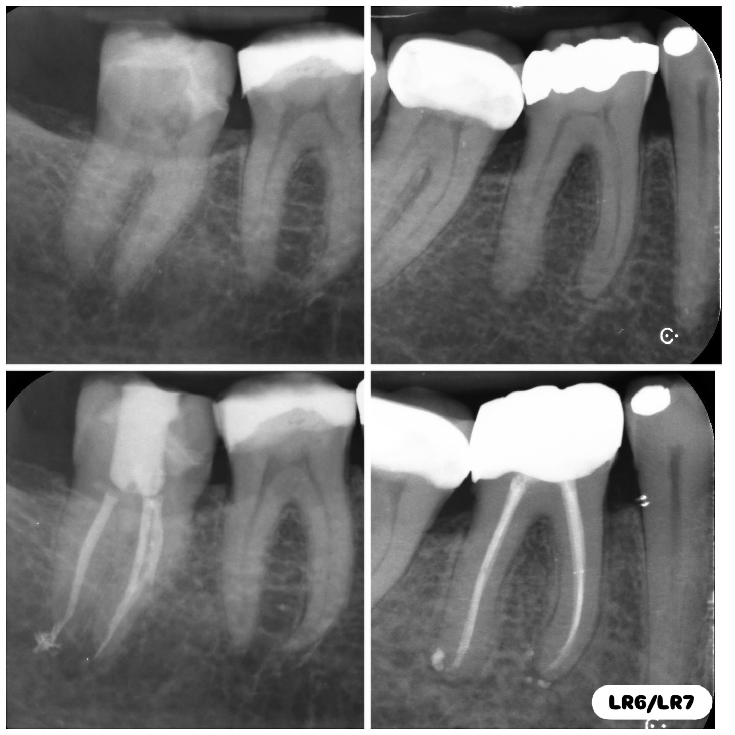 LR7 and LR6 routine endodontic treatments. Activated irrigation. Warm vertical compaction tech #endowarrior #endodontia #rootcanaltreatment #rootcanaltherapy #endobelly #waves #waveonegold #saveteeth #endospecialist #treatyourself #simplicity #dentaltreatment #compositebonding #dentistry #endodontics #dentaltreatment #difficultendo #dentistrylife #dentistrylove #dentallife #oralhealth #veneers #dentalhygiene #healthysmile #dentalhealth #dentures #dentallab #dentalschool #dentalassistant #endodontics