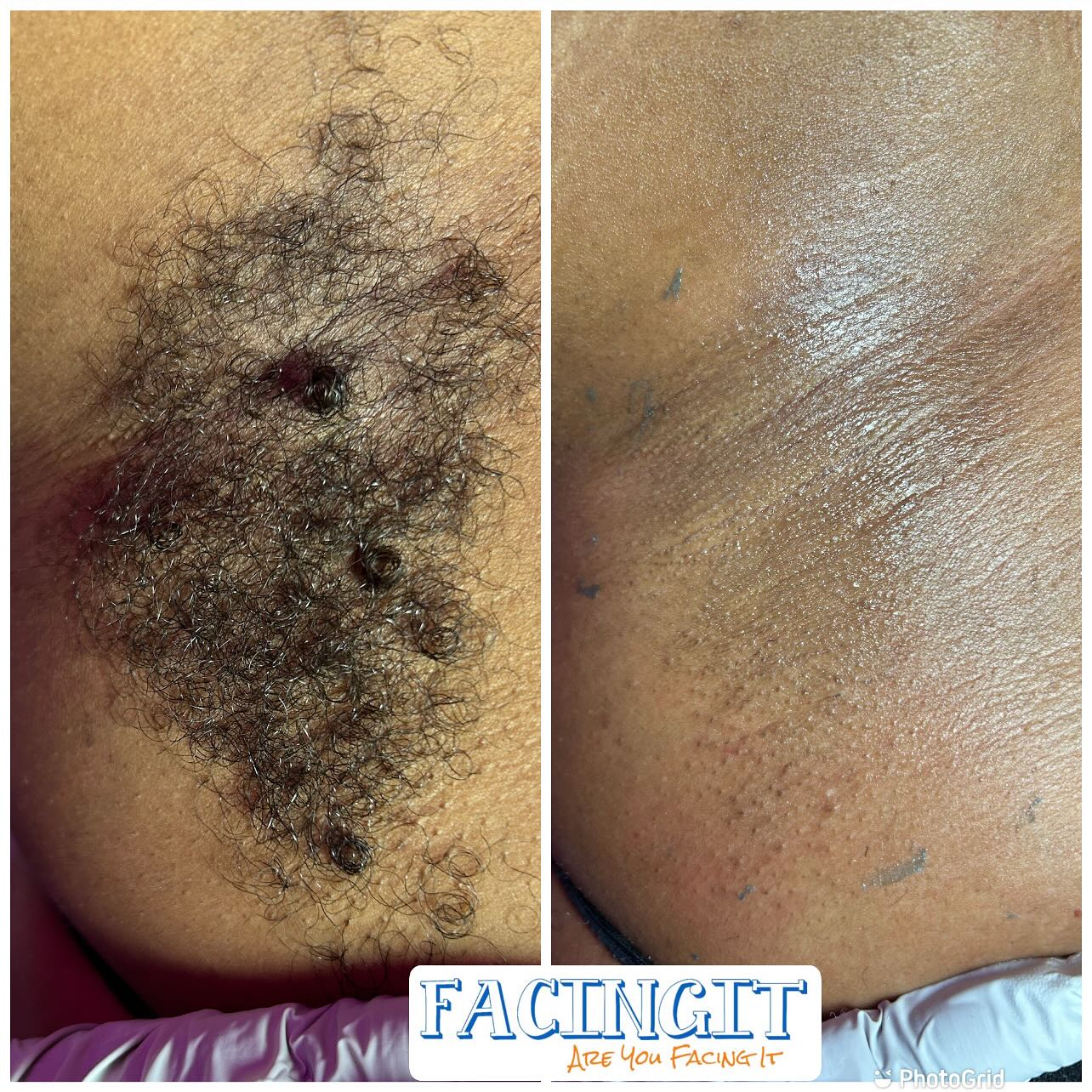 ✨ Facials | Waxing | Body Contouring | Yoni Steams | Sauna Blanket ✨
Come visit FacingIT in East Point, GA—your go-to destination for radiant skin, smooth results, and total body wellness. Whether you’re looking for a refreshing facial, expert waxing, advanced body contouring, or a relaxing yoni steam and sauna blanket session, FacingIT has you covered!
🌐 Book your appointment now at www.aubriafacingit.com
📍 Located in East Point, GA
We offer a variety of personalized services including:
💆♀️ Customized Facials
🧖♀️ Yoni Steams
🔥 Sauna Blanket Detox
🧴 Body Contouring & Wax Combos
🎁 Monthly Specials & Deals
Ready to glow? Click the link, book your service, and don’t forget to refer a friend while you’re there!
#Atlanta #AtlantaLife #AtlantaFood #AtlantaEats #AtlantaNights #AtlantaStyle #AtlantaArt #AtlantaPhotos #AtlantaPhotography #AtlantaStreets #AtlantaTimes #AtlantaLiving #AtlantaLifestyle #AtlantaMoments #AtlantaLove #PeopleOfAtlanta #AtlantaFashion #AtlantaMusic #AtlantaNightlife #AtlantaDaily #AtlantaFitness #AtlantaFit #AtlantaInfluencer
#AtlantaBlog #AtlantaShopping #AtlantaRestaurants #AtlantaFoodie #AtlantaAdventures #AtlantaVibes #AtlantaHomes