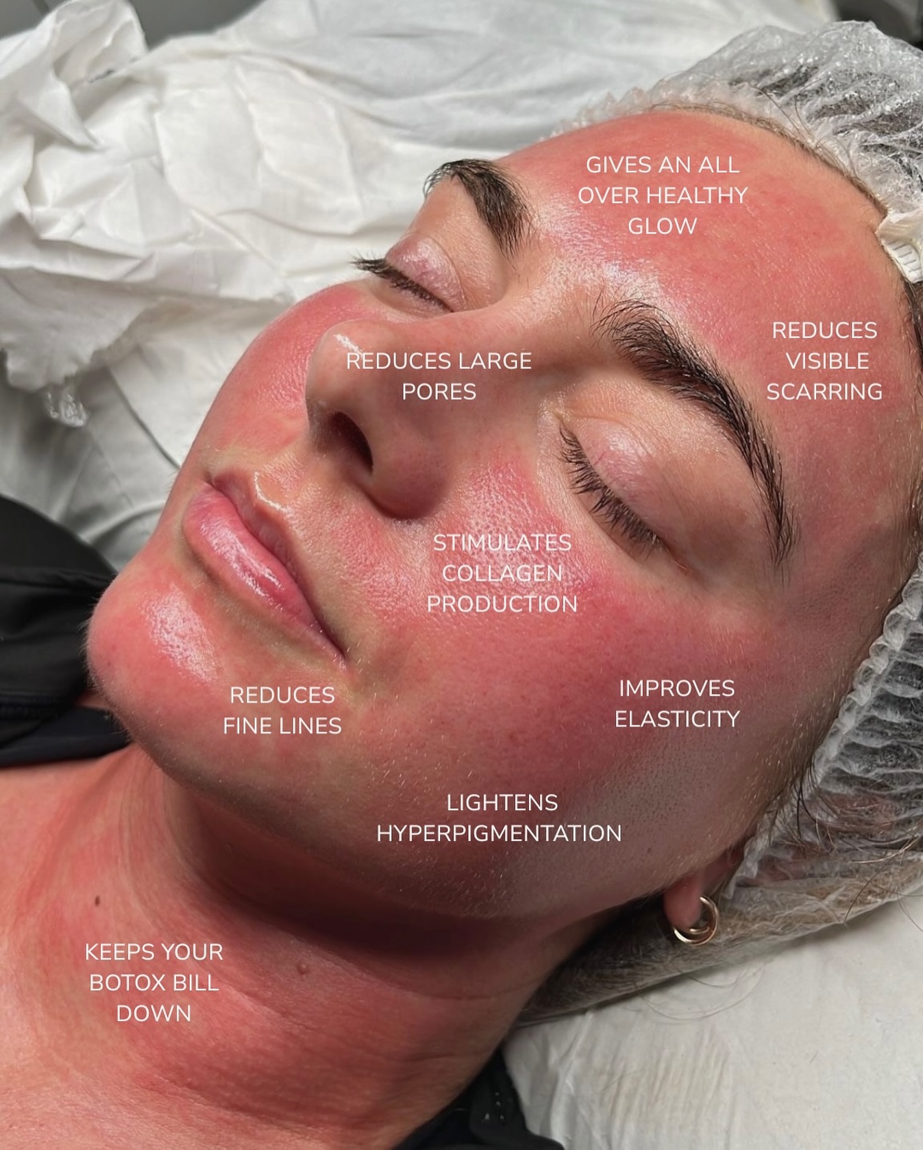 Micro-needling x Radiofrequency = your skin’s new BFF 👯♀️
Thinking about microneedling but have questions? Not sure if it’s right for your skin? This treatment boosts collagen, tightens , and brightens, giving you that real, natural glow without injectables.
DM us ‘GLOW’ and we’ll tell you if you’re a good candidate and answer anything you’re unsure about 💌
#microneedling #radiofrequencyfacial #acnescarring #antiage #microneedlinguk #collagen #collagenboost